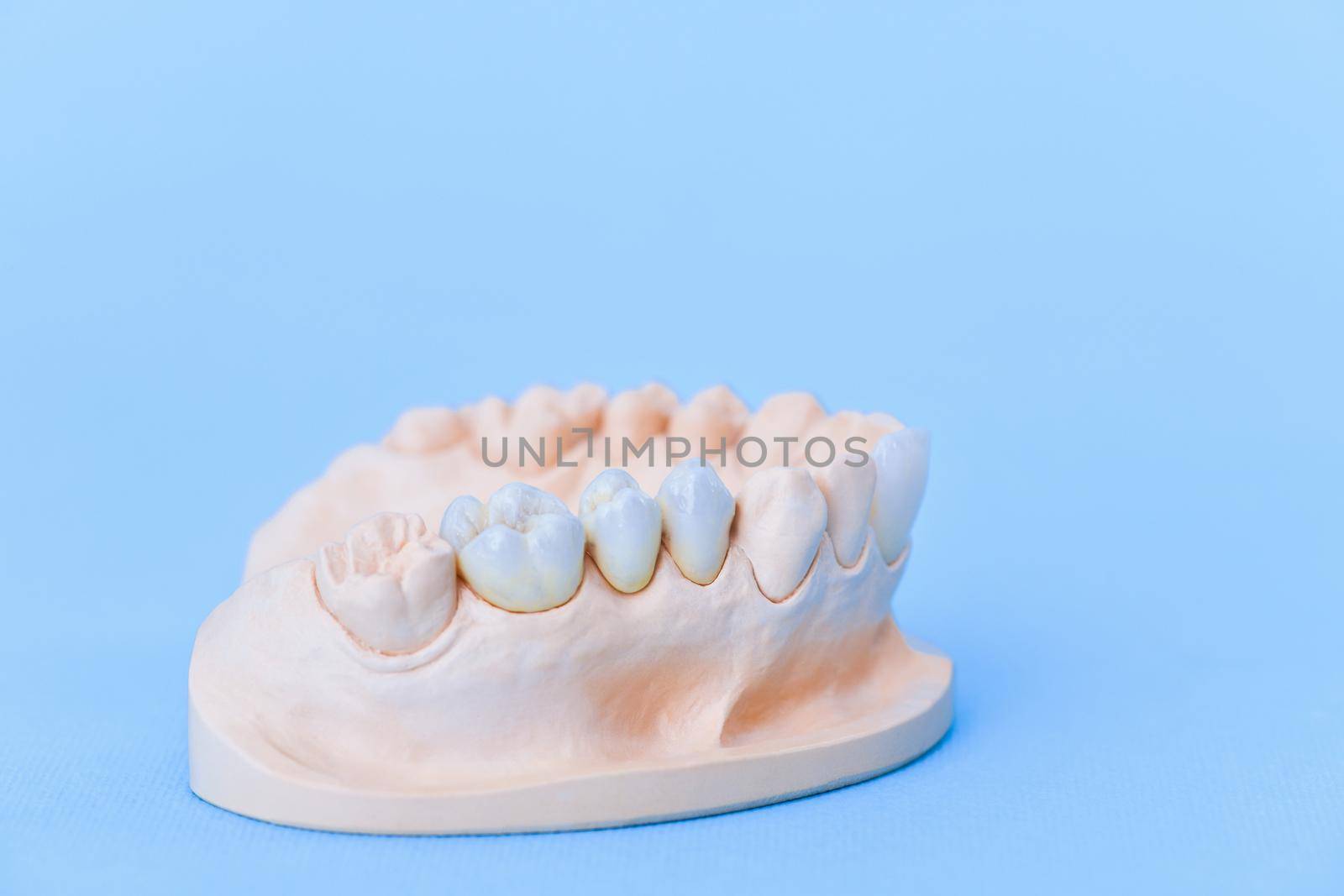 Gypsum model of human jaw with teeth on a blue background
