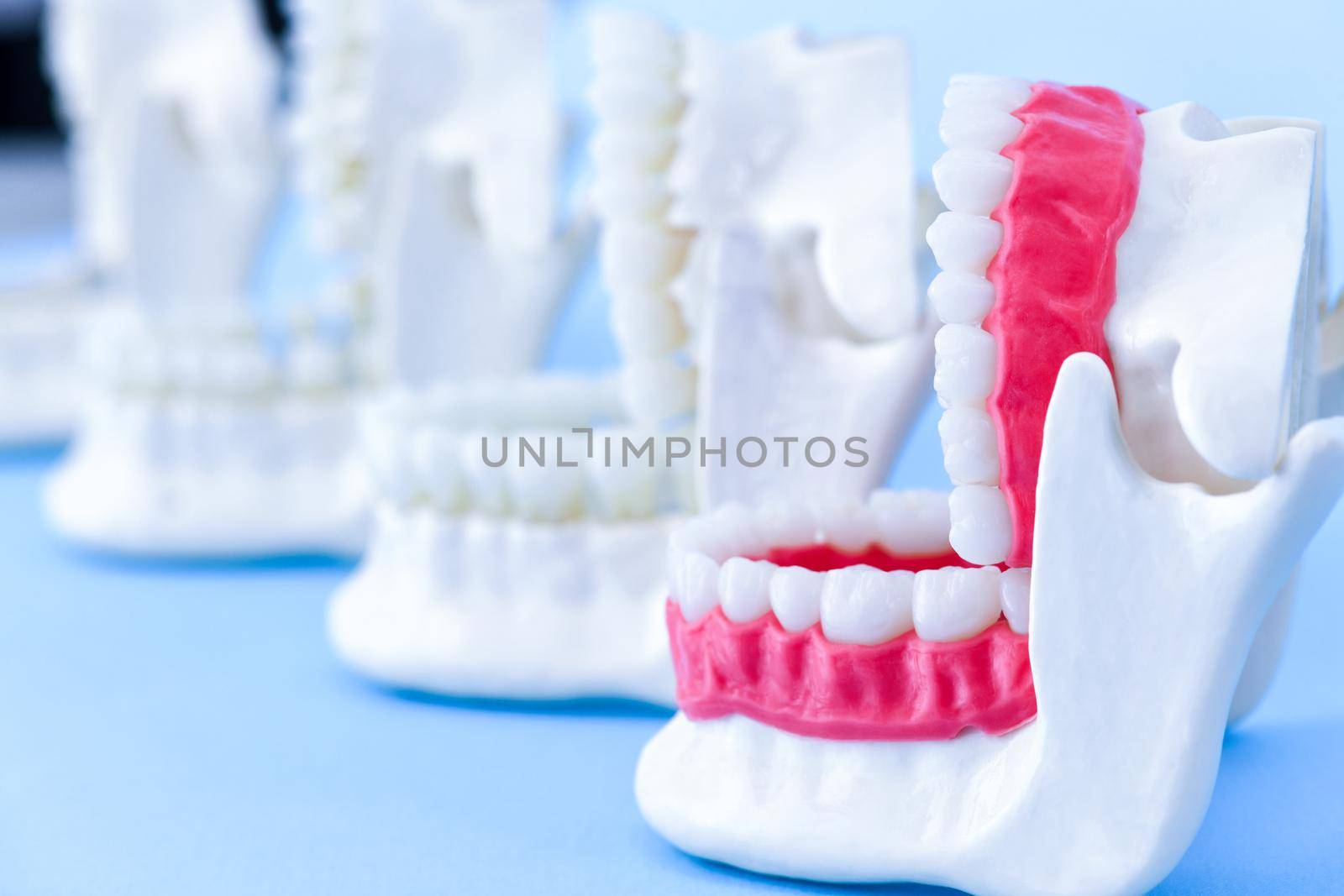 Dentist orthodontic teeth models with jaws opened on blue background