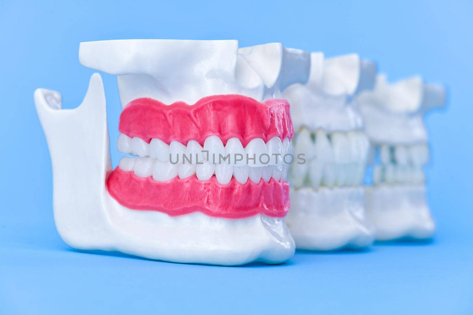 Human jaws with teeth and gums anatomy models medical illustration isolated on blue background. Healthy teeth, dental care and orthodontic concept