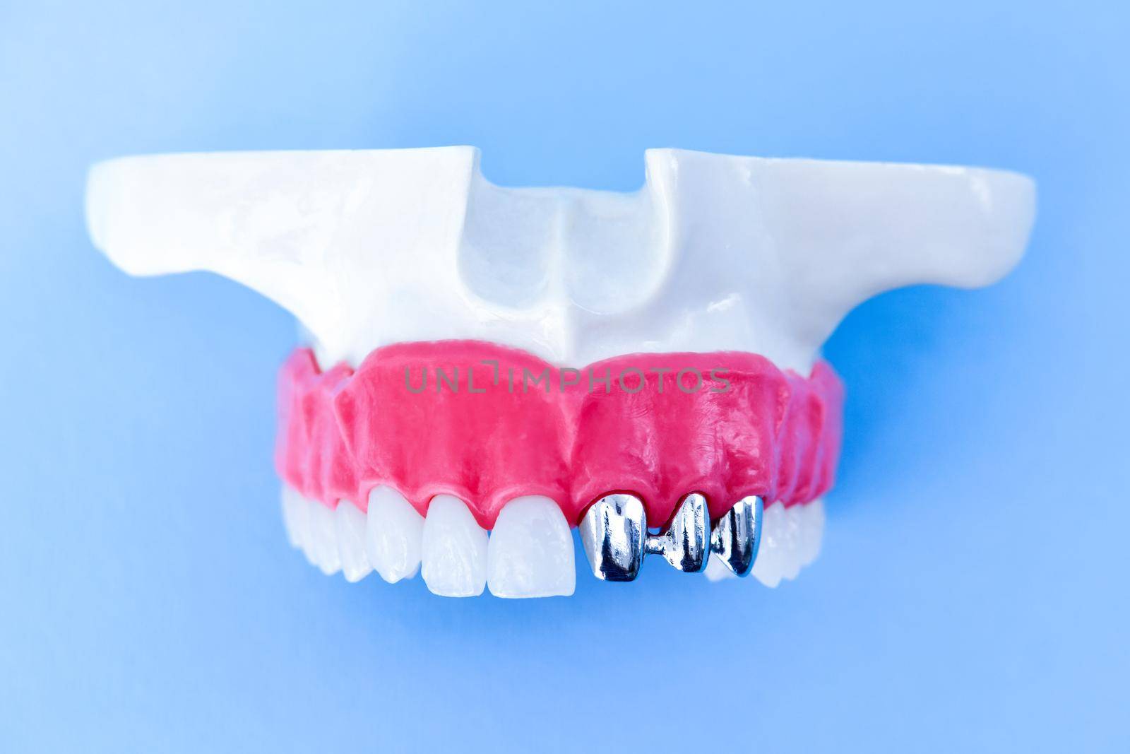 Tooth implant and crown installation process by dotshock