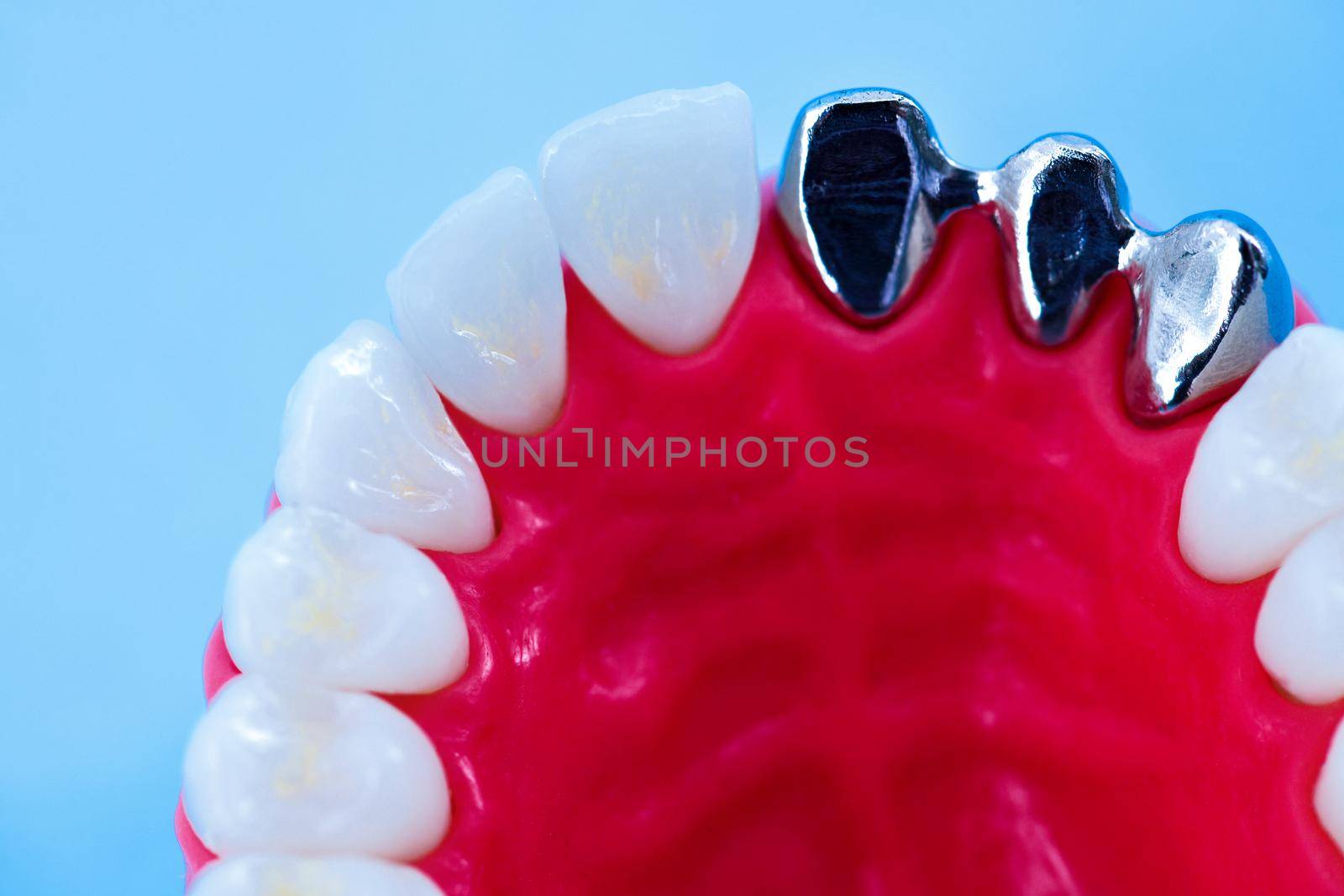 Tooth implant and crown installation process by dotshock