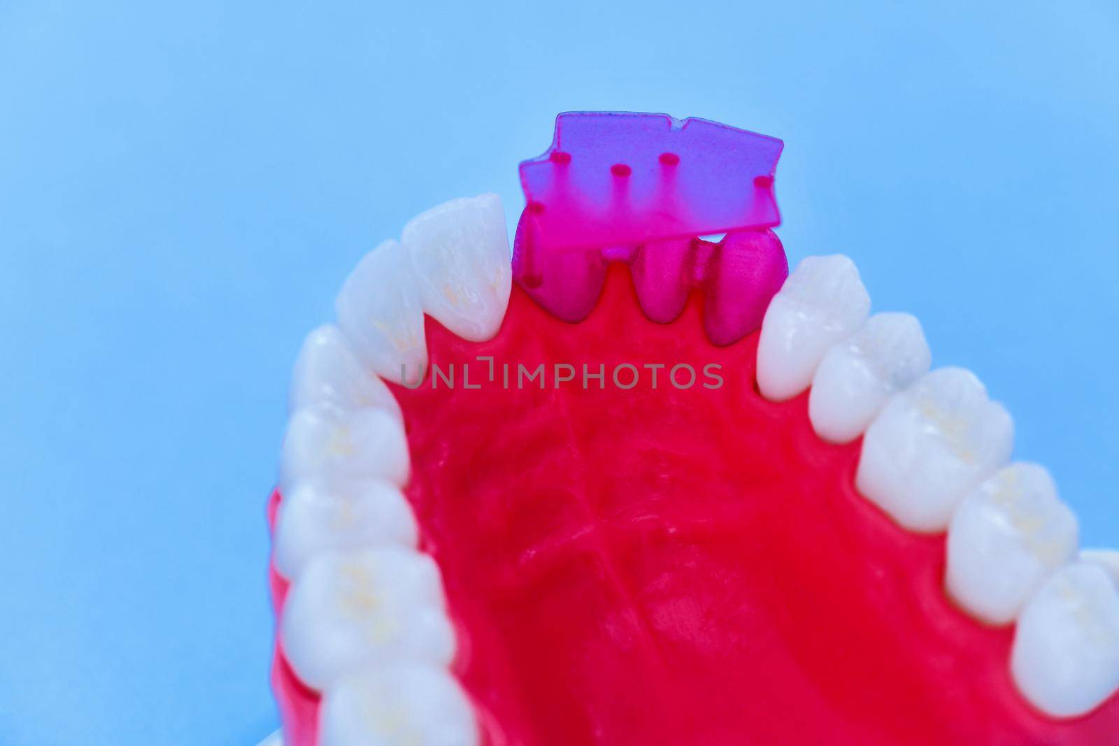 Teeth implant and crown installation process isolated on a blue background. Medically accurate 3D illustration