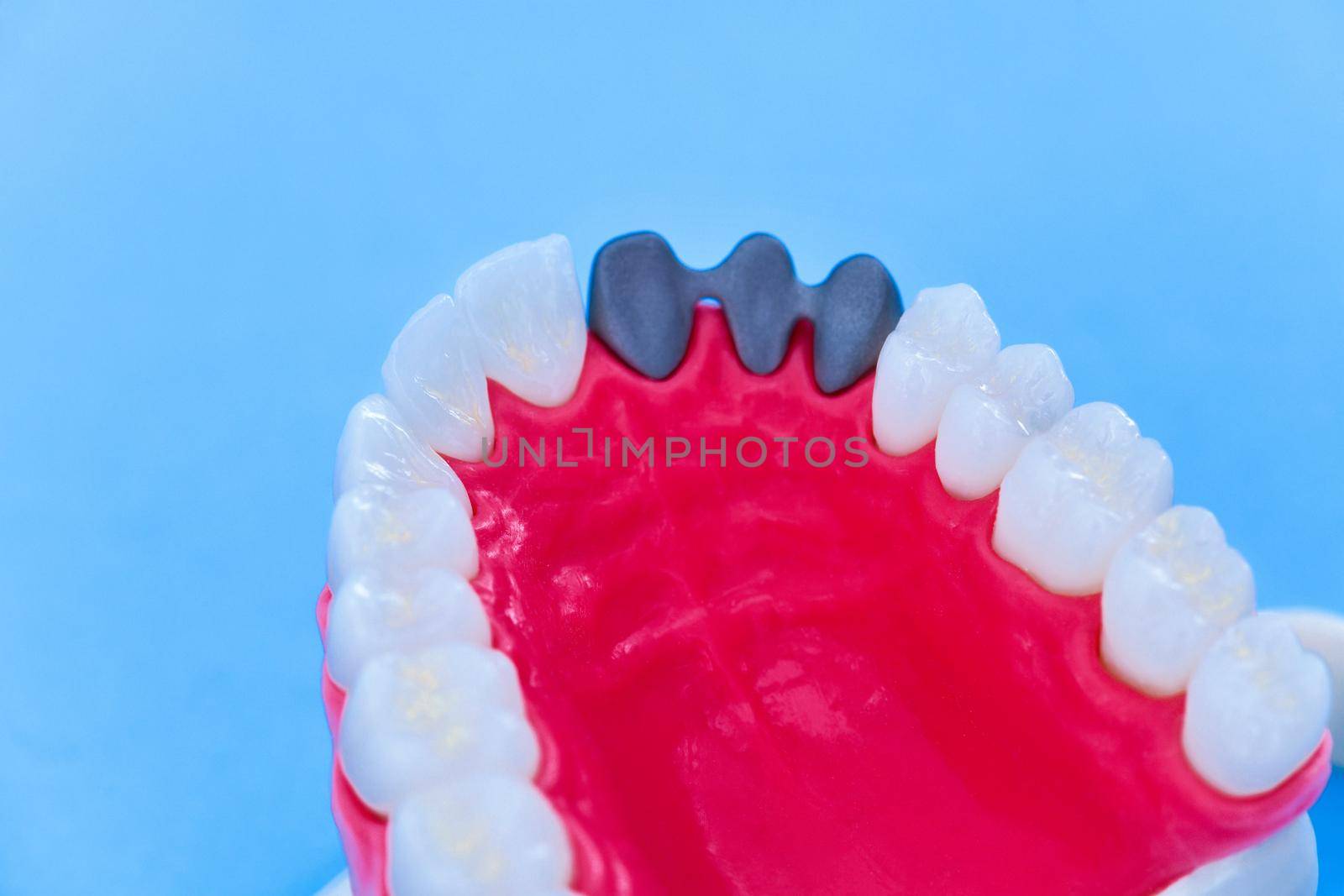 Teeth implant and crown installation process isolated on a blue background. Medically accurate 3D illustration