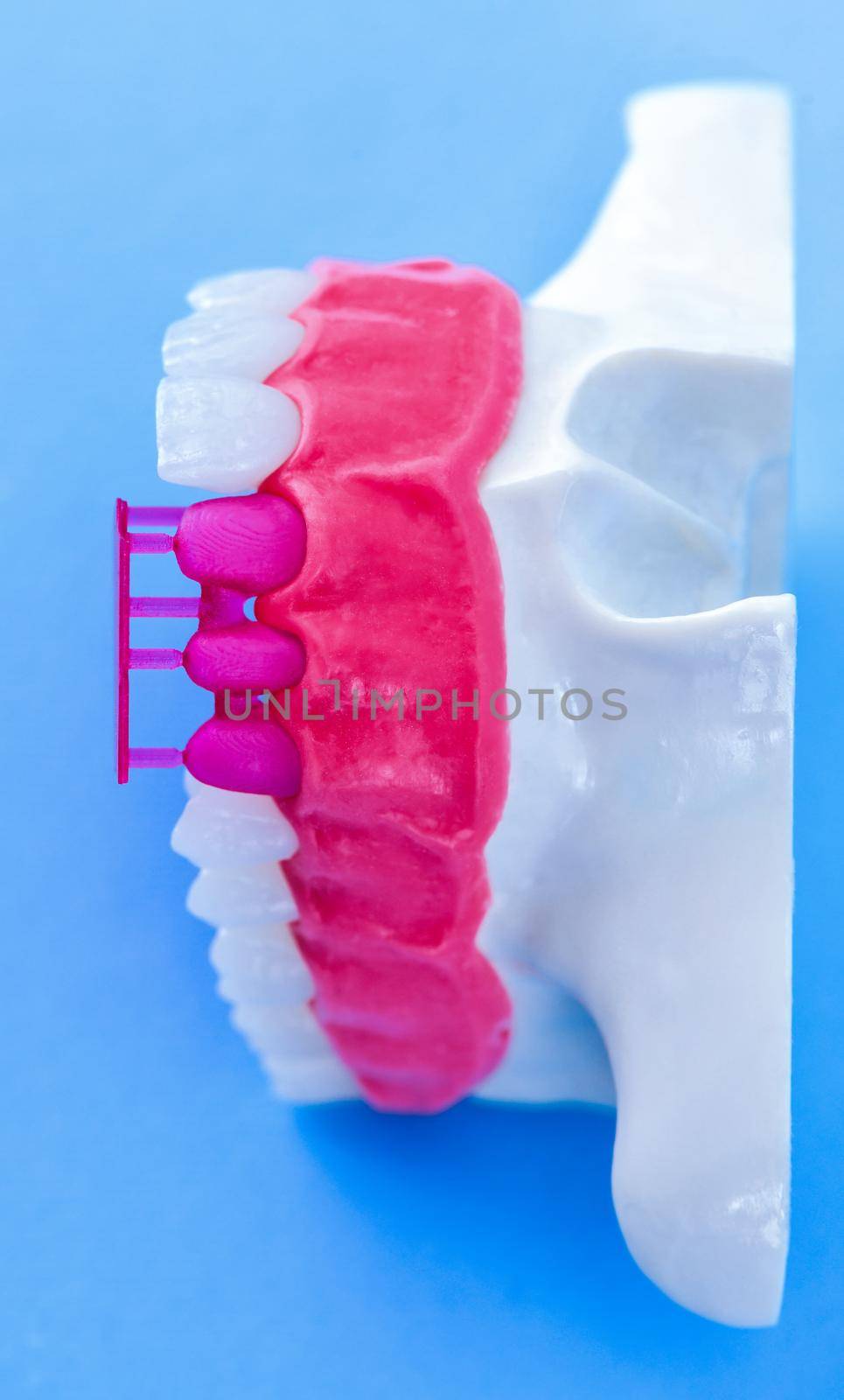 Tooth implant and crown installation process by dotshock