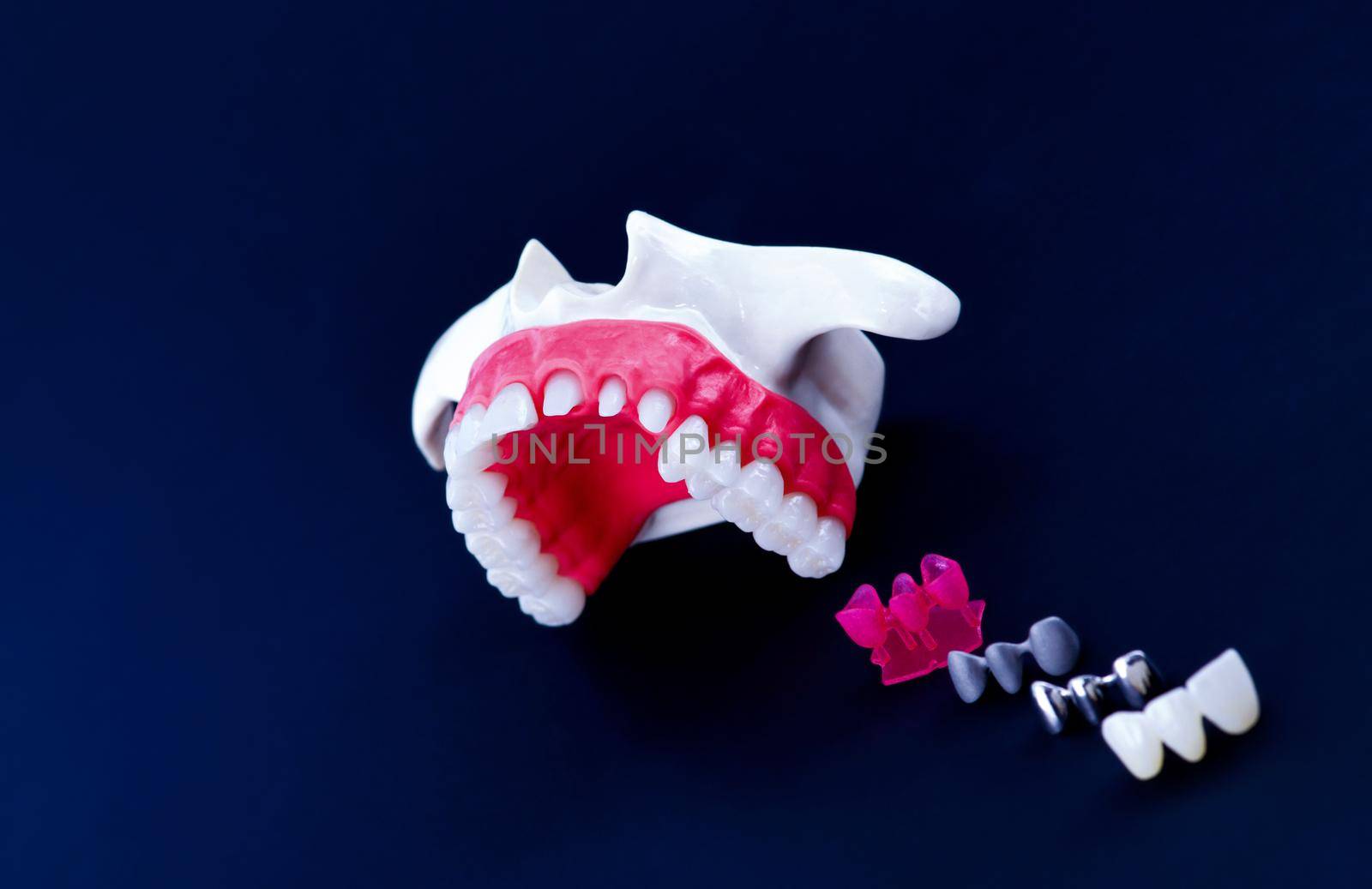 Tooth implant and crown installation process by dotshock