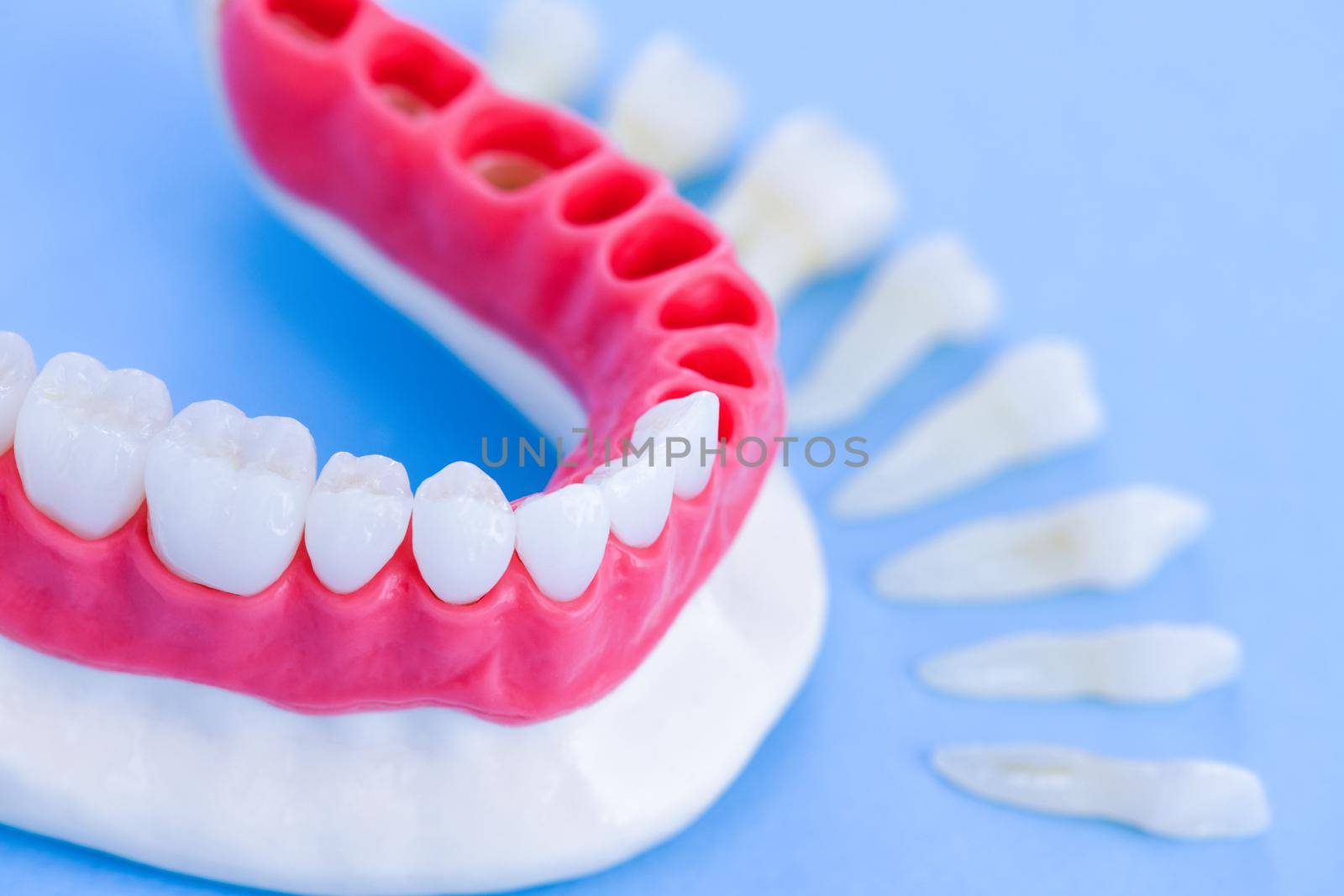 Teeth implant and crown installation process isolated on a blue background. Medically accurate 3D illustration