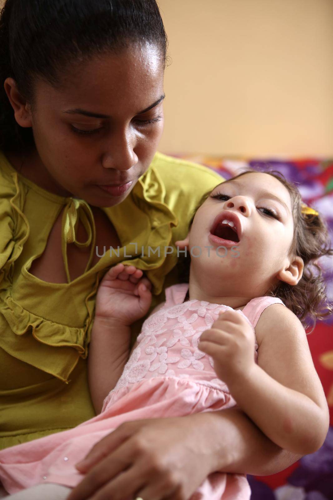 salvador, bahia, brazil - september 27, 2017: mother sucks her daughter with microcephaly caused by zica virus during pregnancy in the city of Salvador.