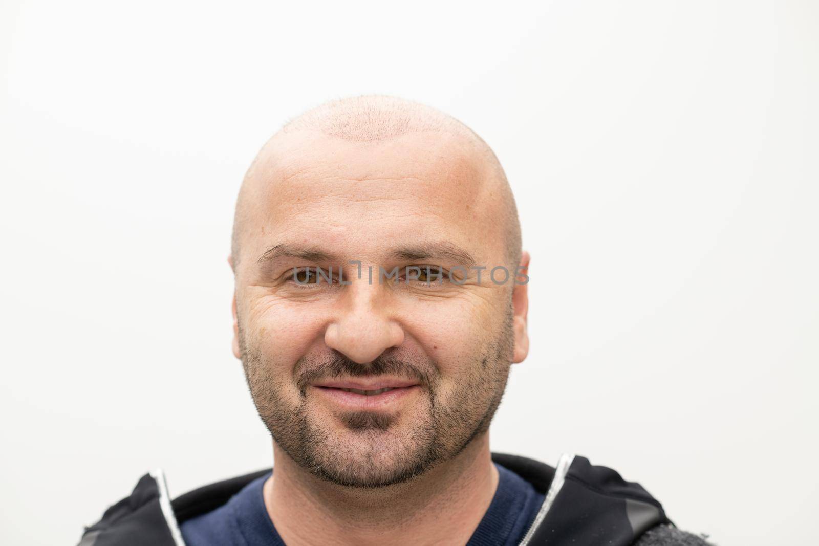 closeup portrait of bald man after hair implantation therapy