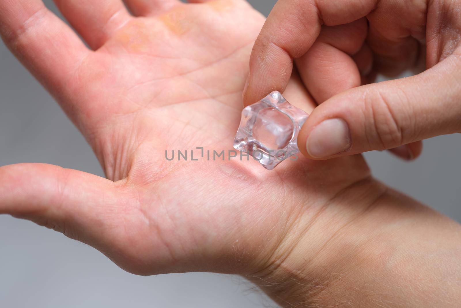 A man's hand is rubbing calluses with an ice cube by kuprevich