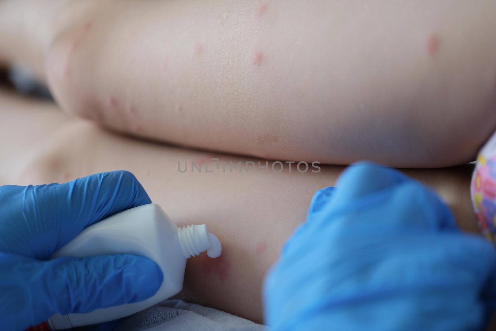 Close-up of doctor examining red rash on child legs in clinic and apply cream. Kids naked legs on appointment, irritation on body. Medicine, health concept