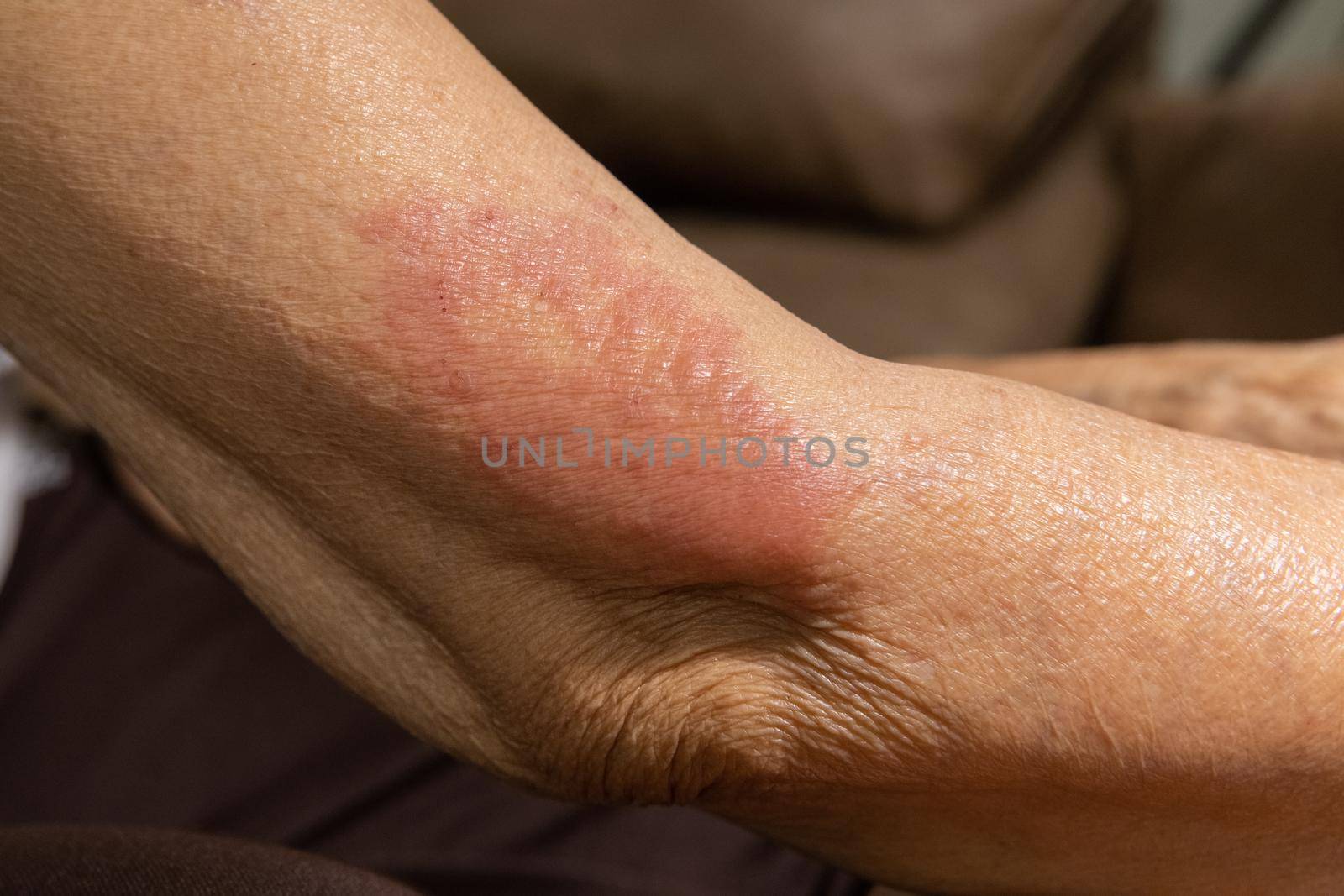 vaccine covid 19 allergies symptom in elderly after vaccination.