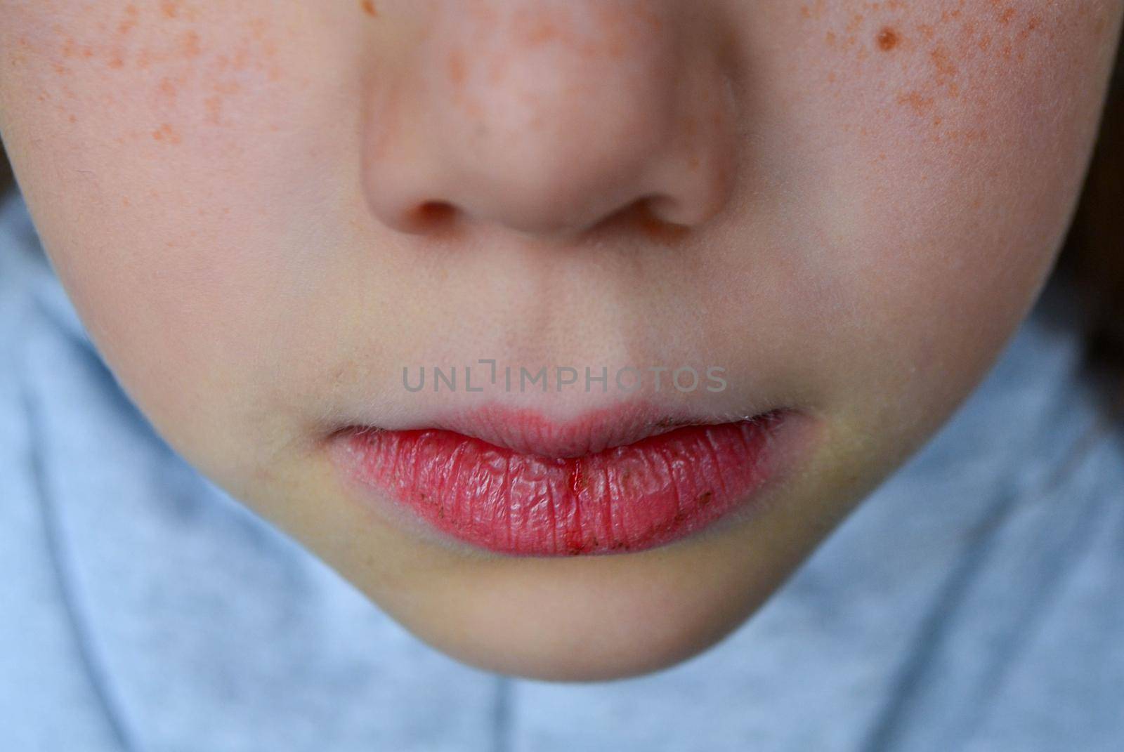 Dry and damaged lips of a girl. Close-up. Lip fissure and bleeding. Sick cracked damaged tissue. Dry lips with cracks, dry mouth, Closeup face with brittle and dry lips, dehydration High quality photo