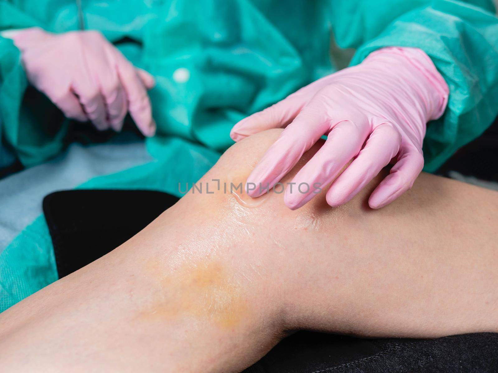 Close-up Applying a healing ointment to a bruise on the leg. Family doctor examines leg injury