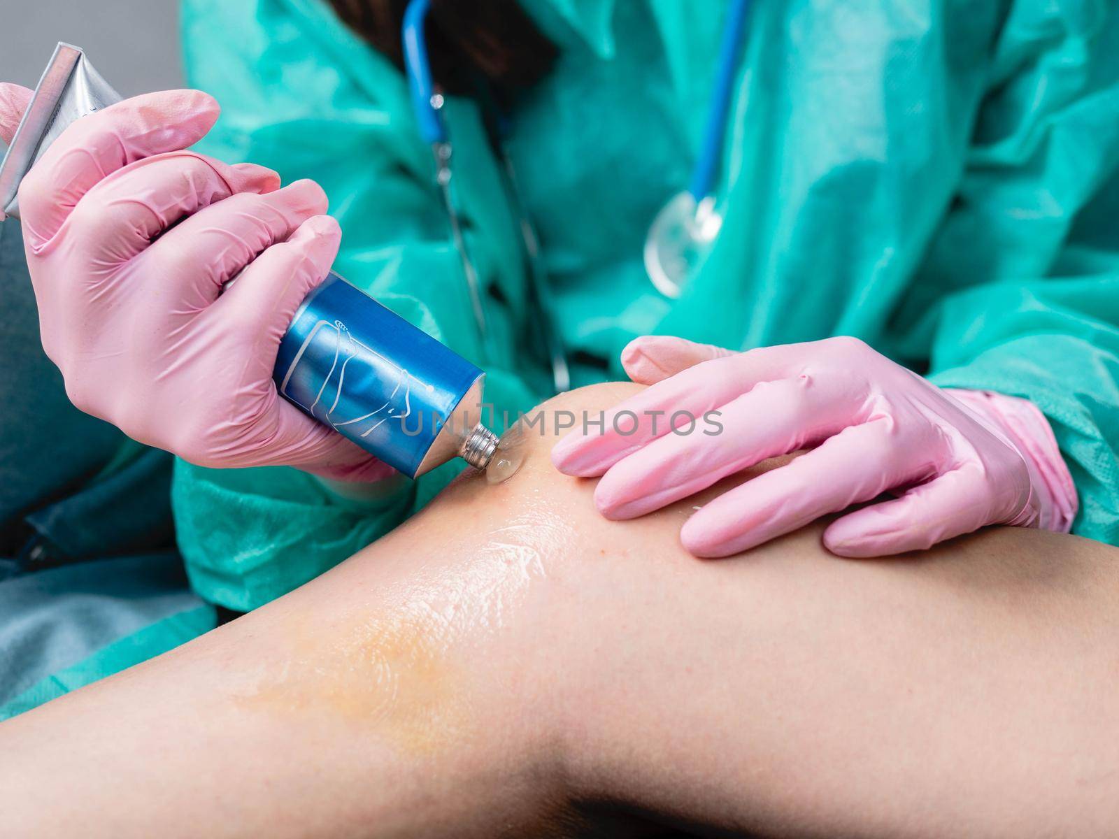 A doctor in medical gloves applies an anesthetic cream to a hematoma of a patient's knee in a clinic. by Utlanov