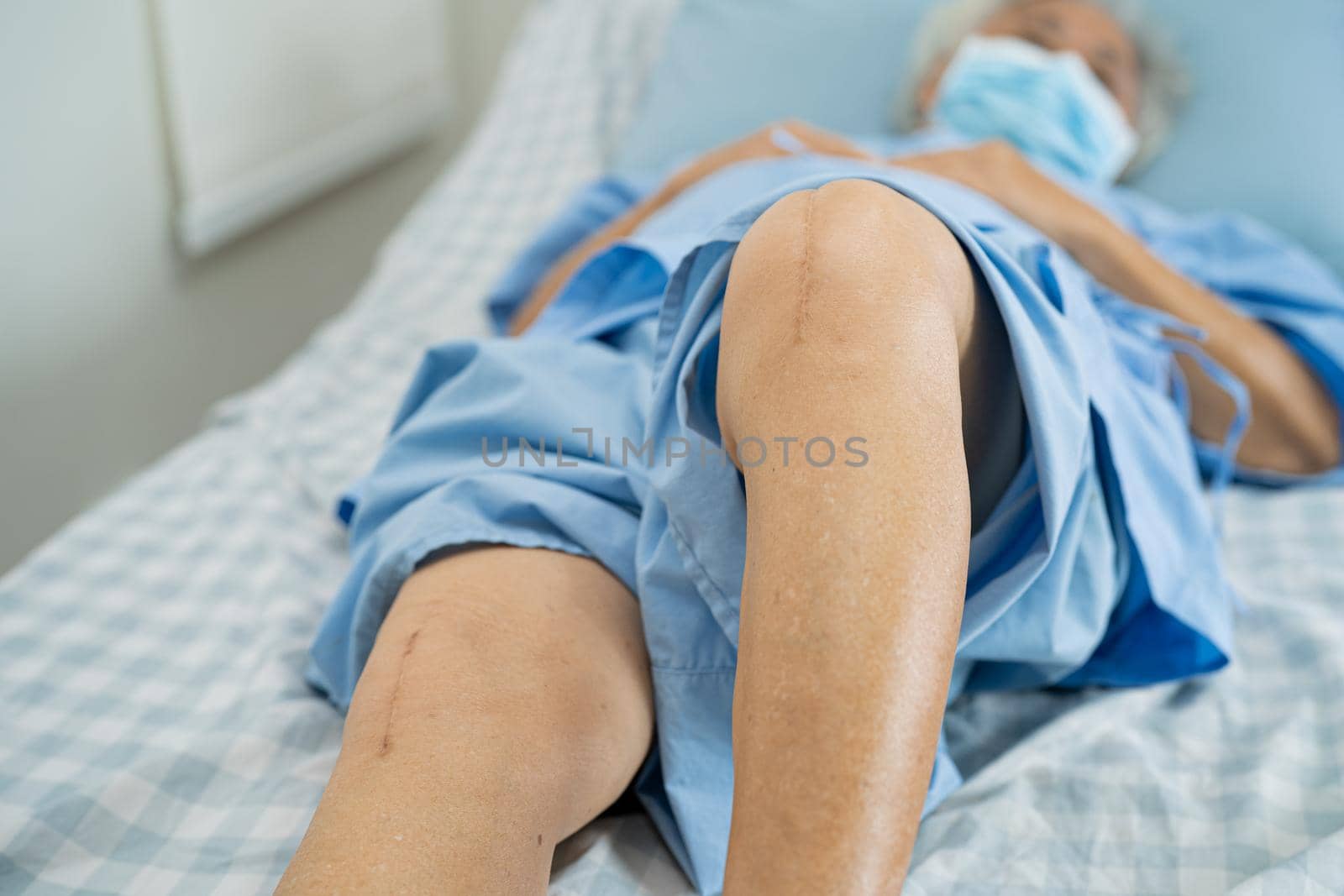 Asian senior or elderly old lady woman patient show her scars surgical total knee joint replacement Suture wound surgery arthroplasty on bed in nursing hospital ward, healthy strong medical concept. by pamai