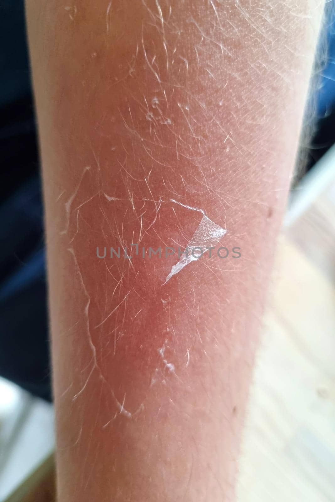 Human hand skin that is flaky due to sunburn, peeling of skin. by kip02kas