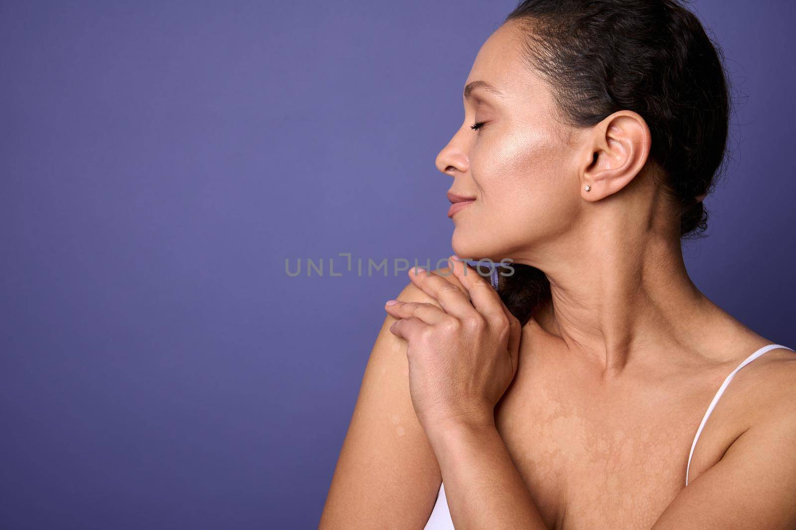 Confident closeup portrait. Delightful natural beauty woman with vitiligo dermatological skin problems smiling, hugging herself against purple background. Body positivity, self-acceptance. Copy space by artgf