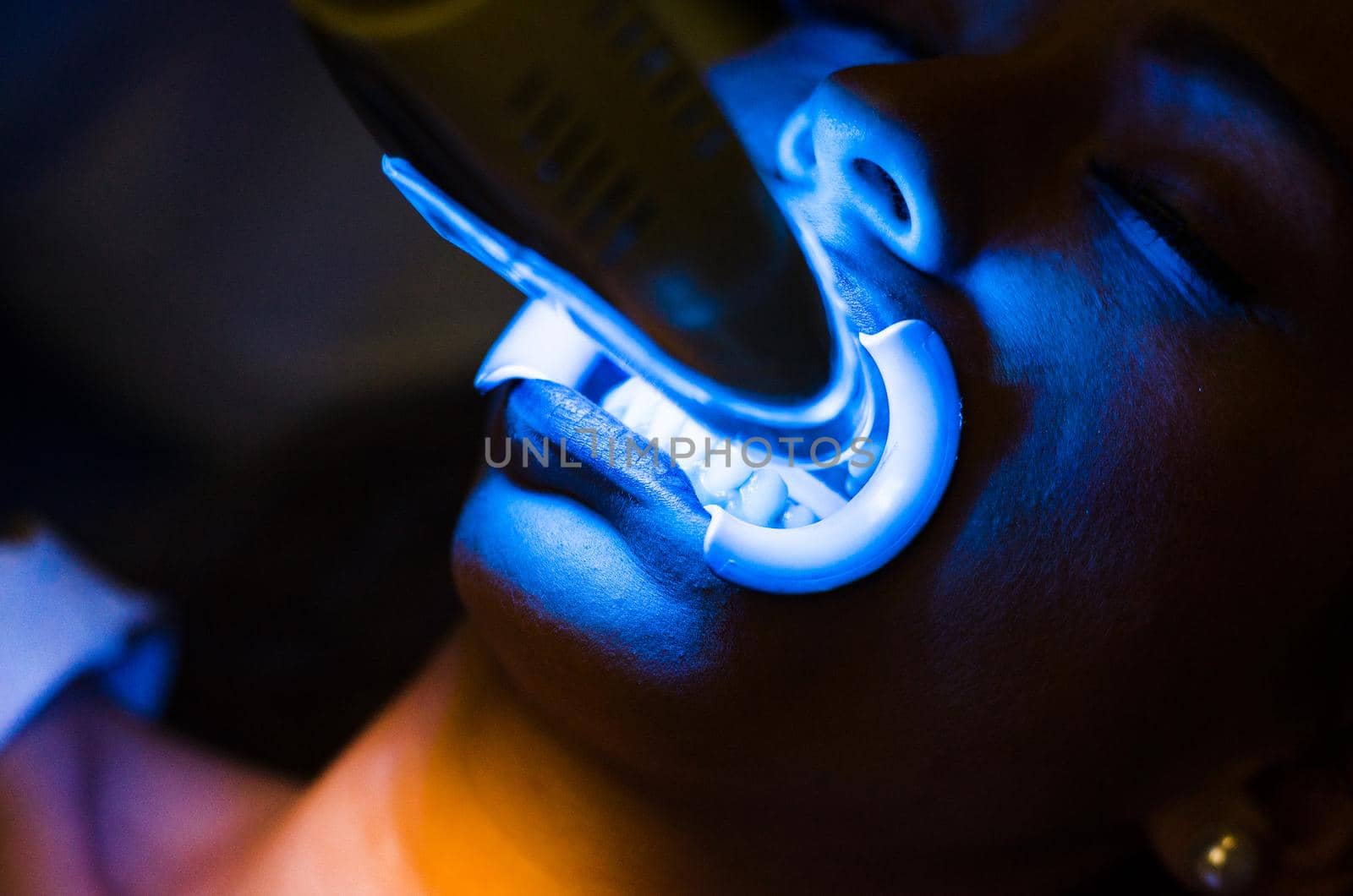 Face of a woman in a dental clinic doing teeth whitening . by Peruphotoart