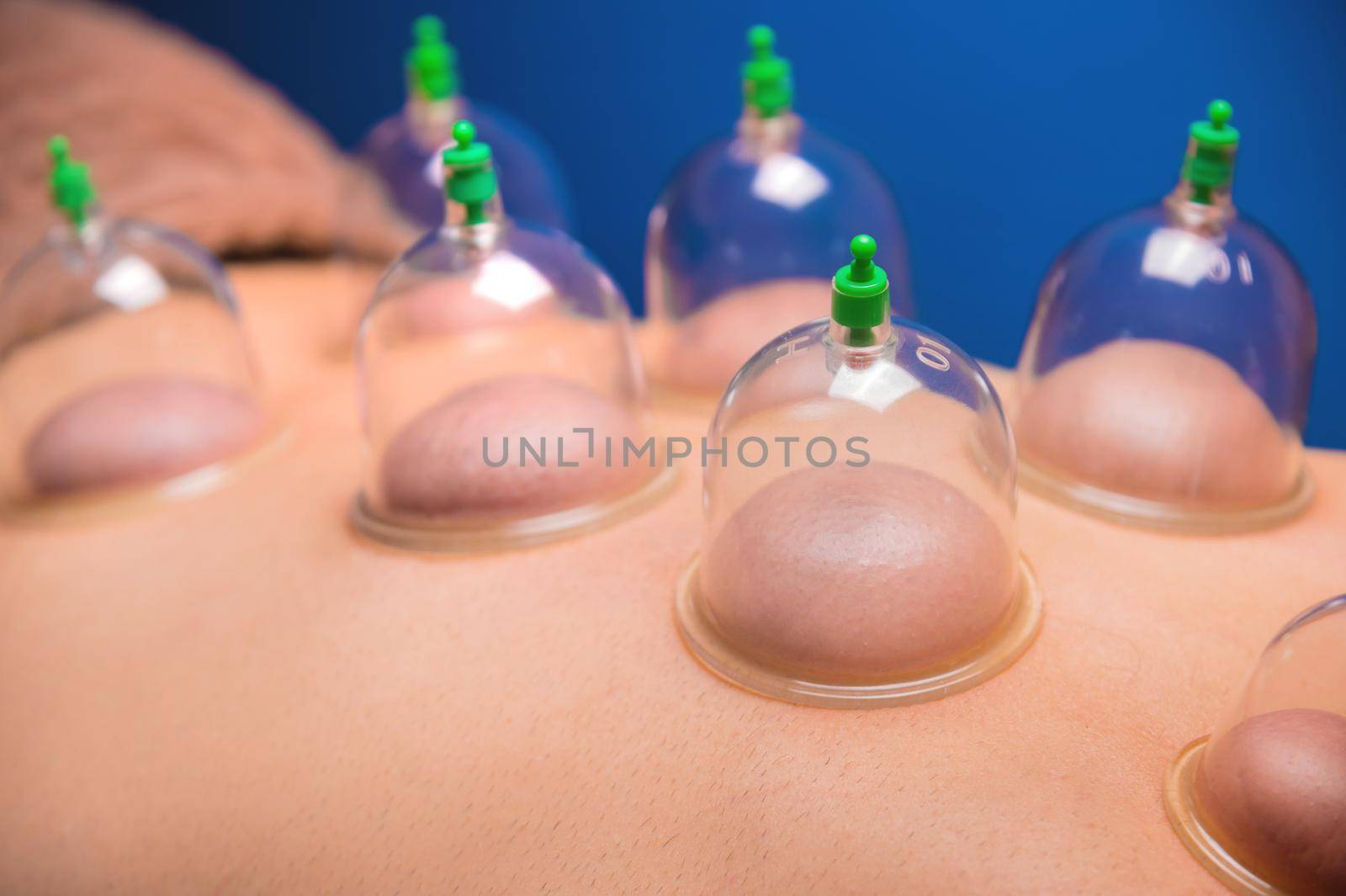 Man lying down recovering health with vacuum cups. Close-up of vacuum cups on the back of a man against a black-blue background. Traditional oriental medicine