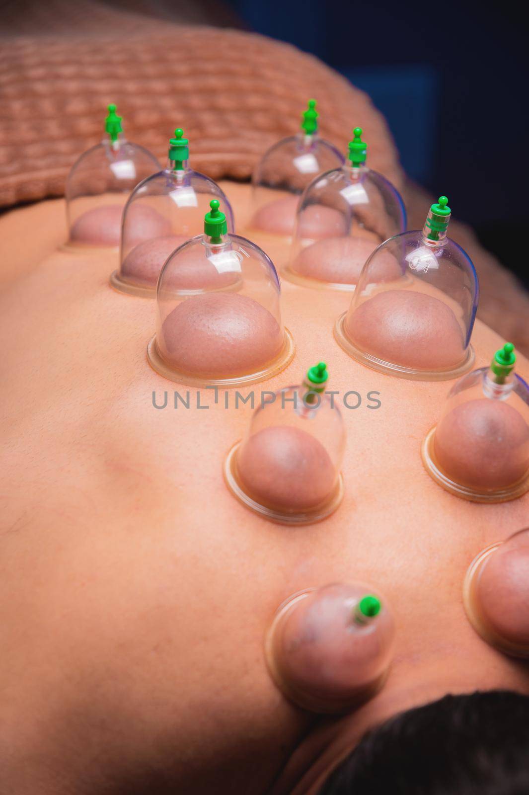 Man lying down recovering health with vacuum cups. Close-up of vacuum cups on the back of a man against a black-blue background. Traditional oriental medicine