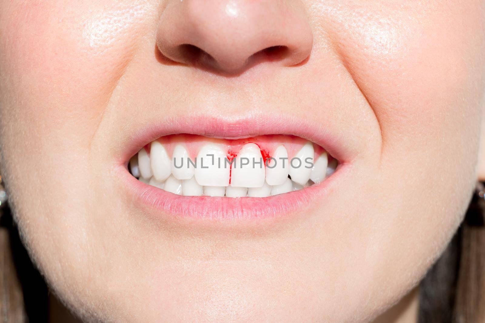 Woman mouth with bleeding gums. Periodontal disease by DariaKulkova