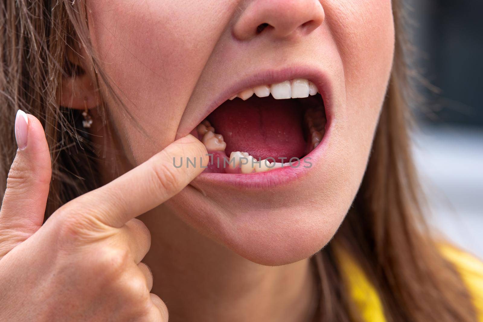 Young woman without tooth on lower jaw. Missing tooth. Waiting an implant after tooth extraction. High quality photo