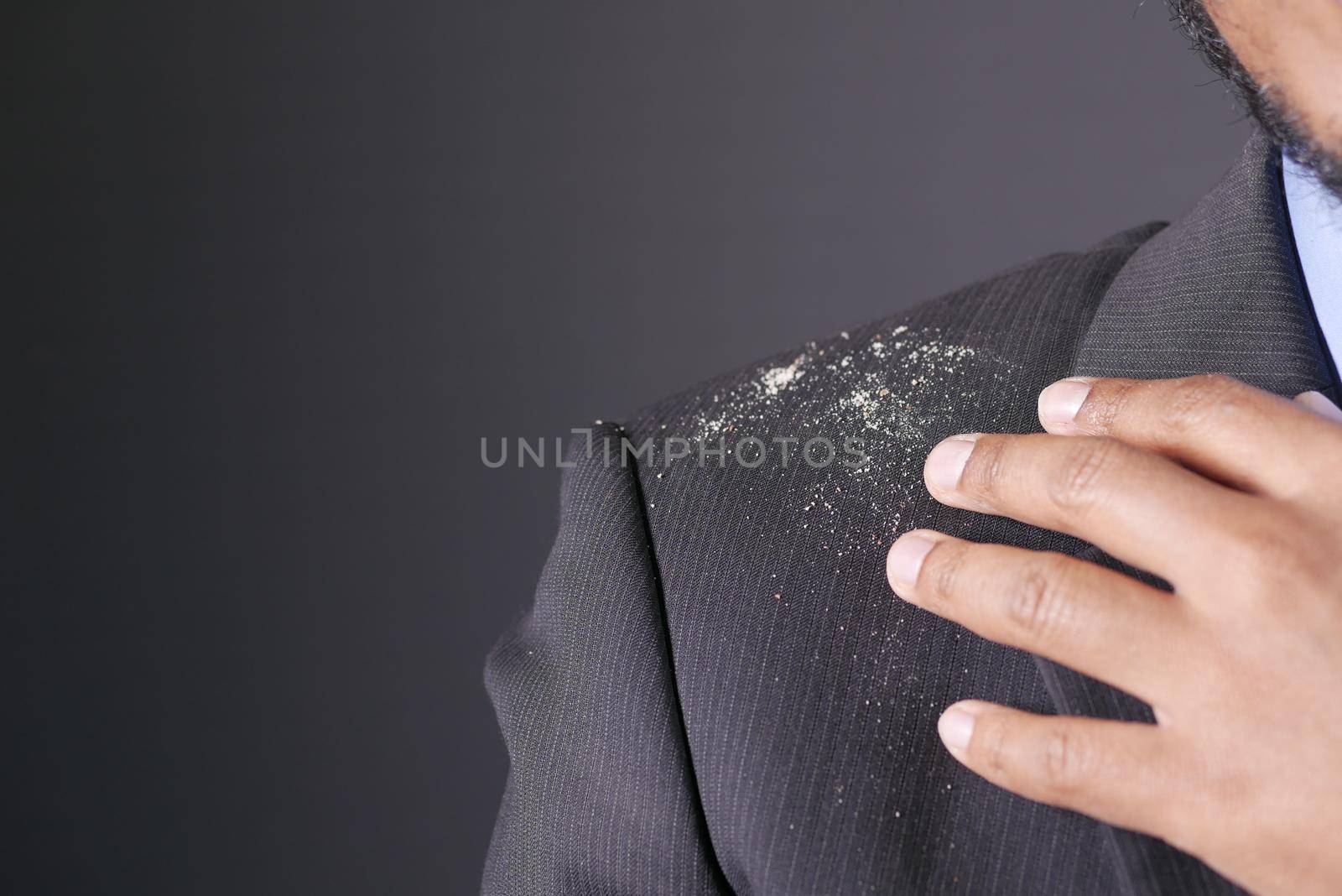 men with dandruff i on his coat .