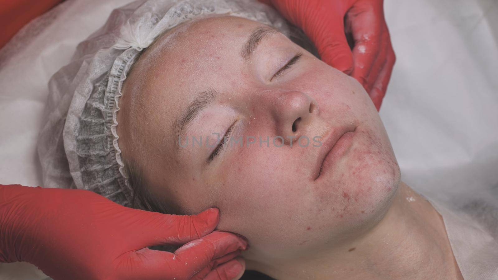 Applying powder to the client's face and massage the client's problem skin