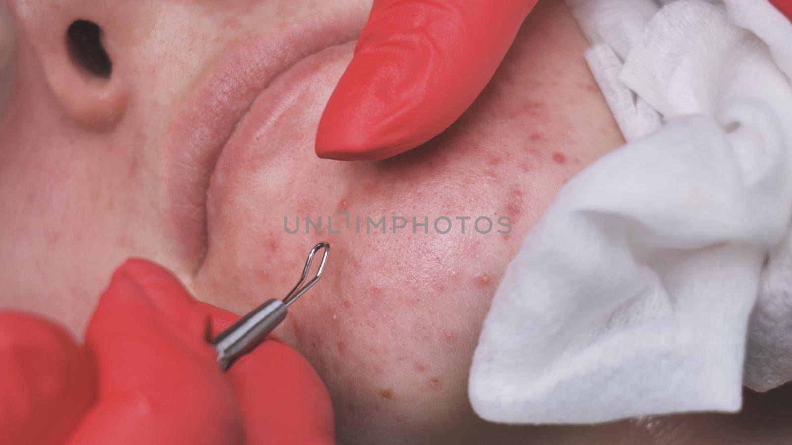 Squeezing acne from a girl with problem skin in the salon using a loop. by DovidPro