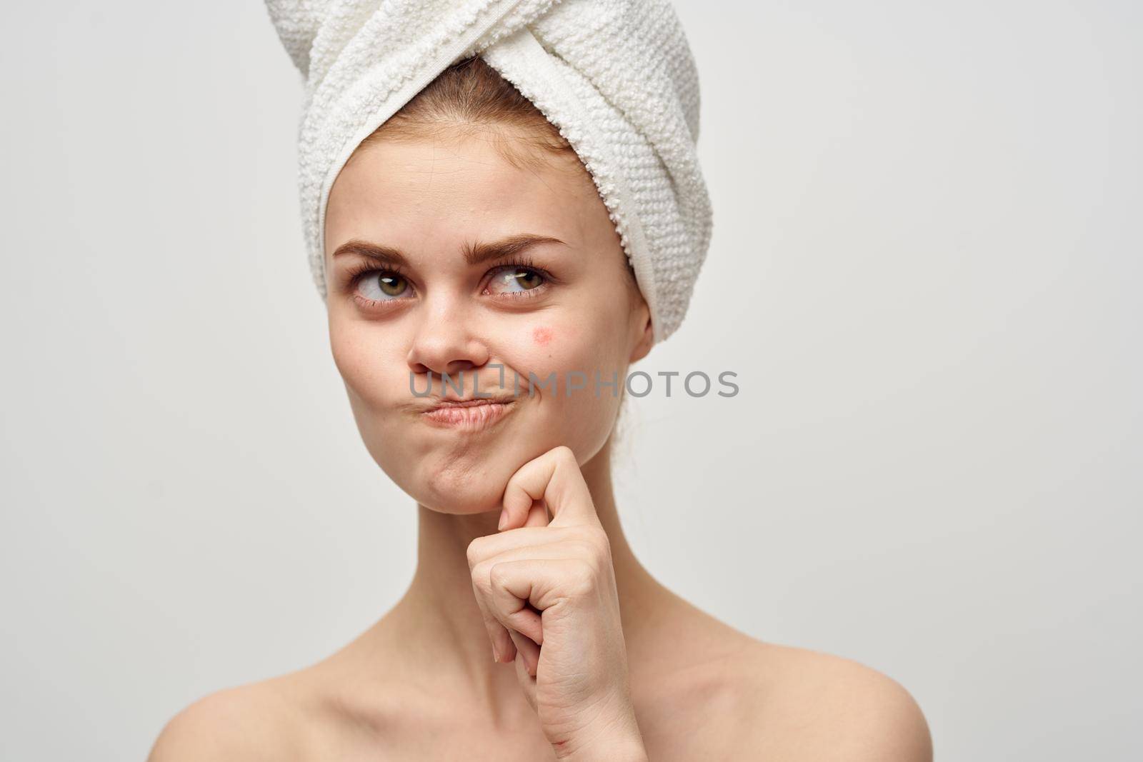 woman with a pimple on the face skin problems close-up by SHOTPRIME