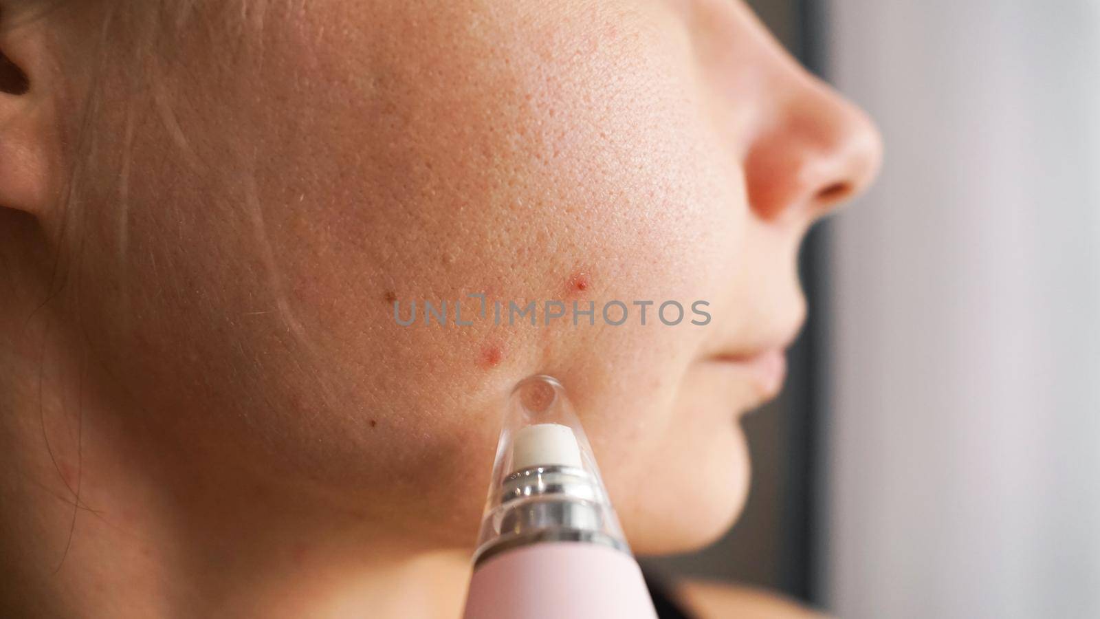 Vacuum device for removing blackheads and acne from the face. Home cosmetology concept