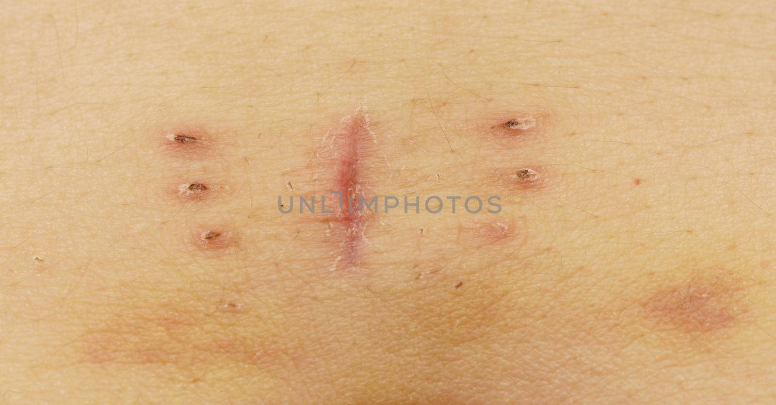 Scar with bruise closeup after hysterectomy by FerradalFCG