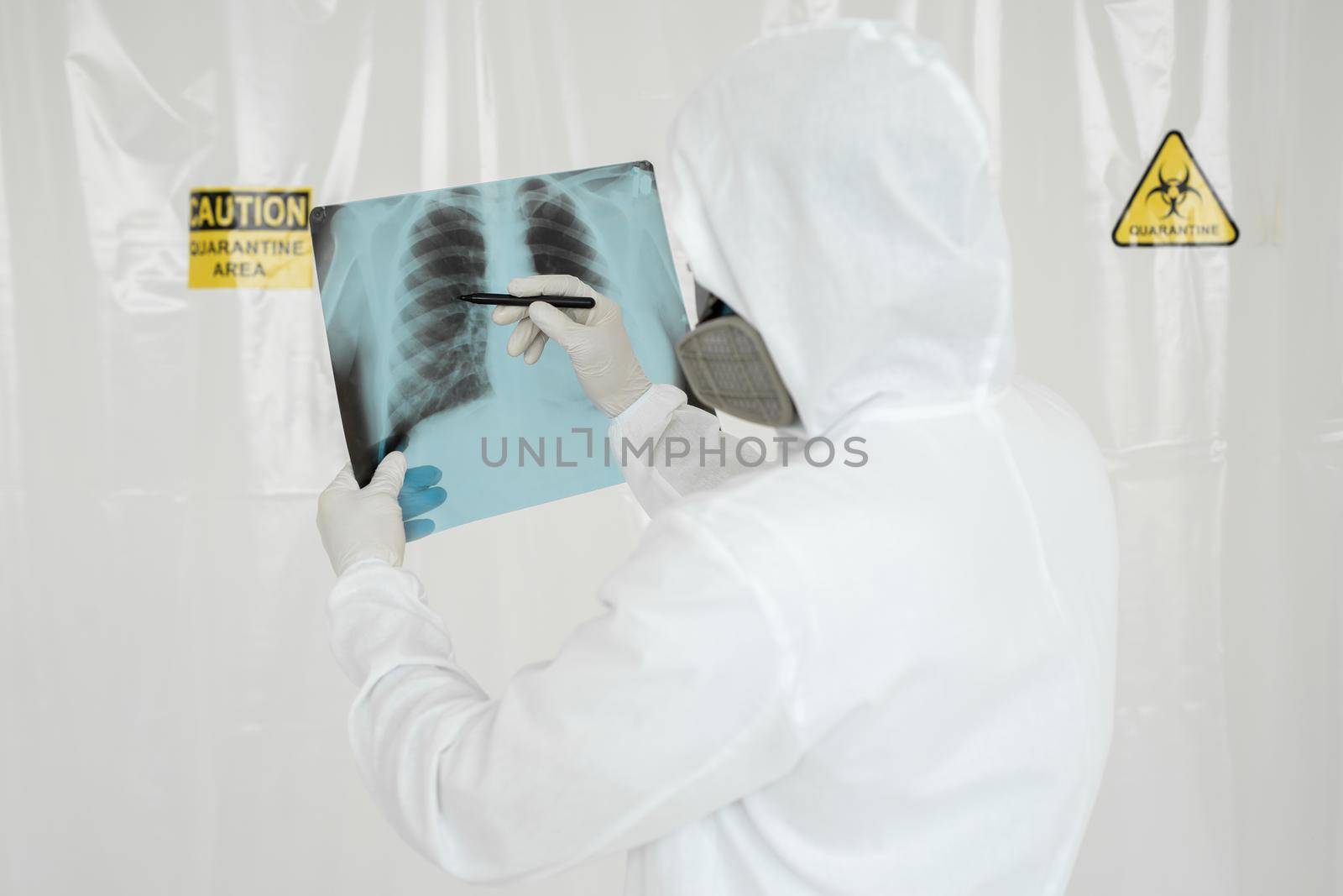 Epidemiologist draws a marker on the x-ray lung lesion covid-19. Coronavirus concept
