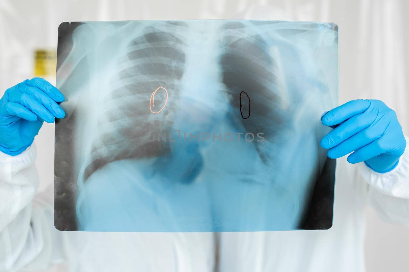 Epidemiologists in respirators examine the patient's pneumonia on a radiograph Covid-19. Concept of coronavirus by StudioPeace