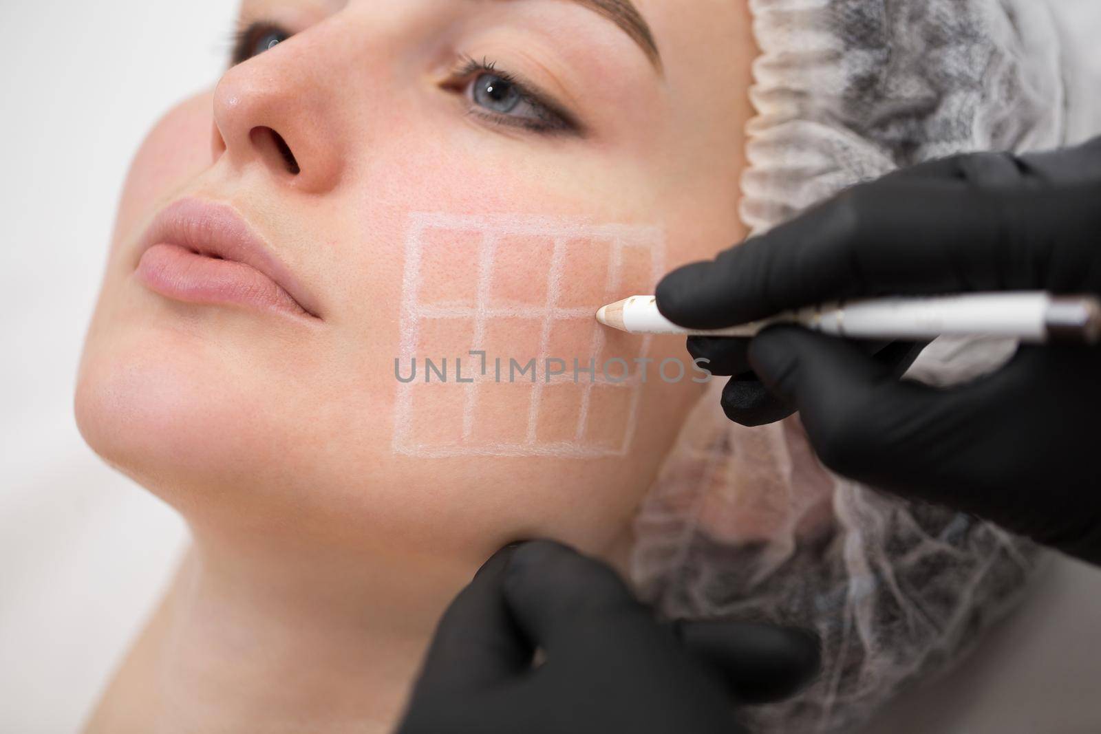Beautician draws the contours of a white pencil on the face of the patient. Schematic marking before contouring. Close-up preparation of the face for cosmetic plastic surgery. by StudioPeace