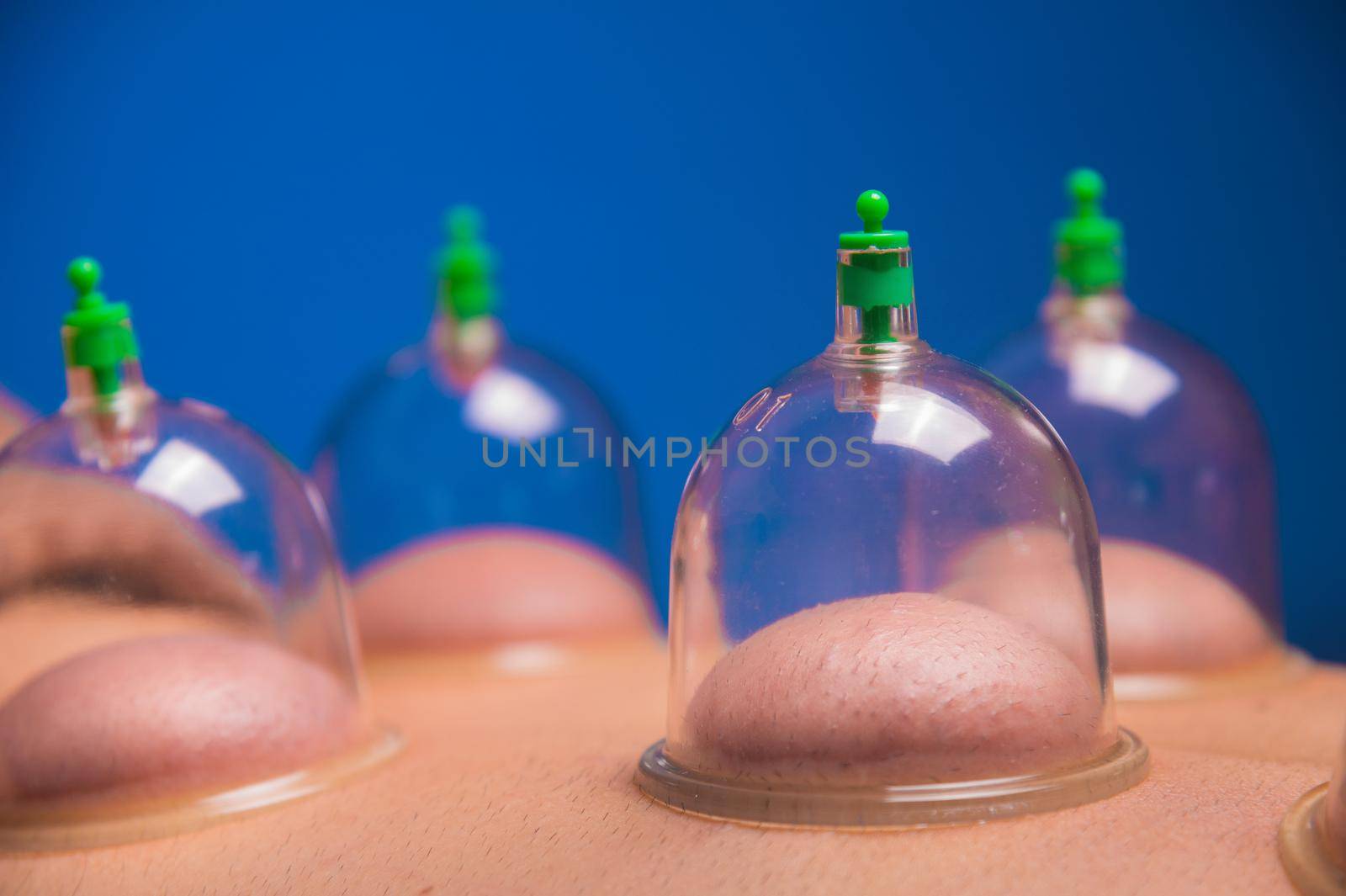 Close-up of vacuum cans installed on the lower back of a patient in a massage parlour. Cups on the back of a massage therapist client.