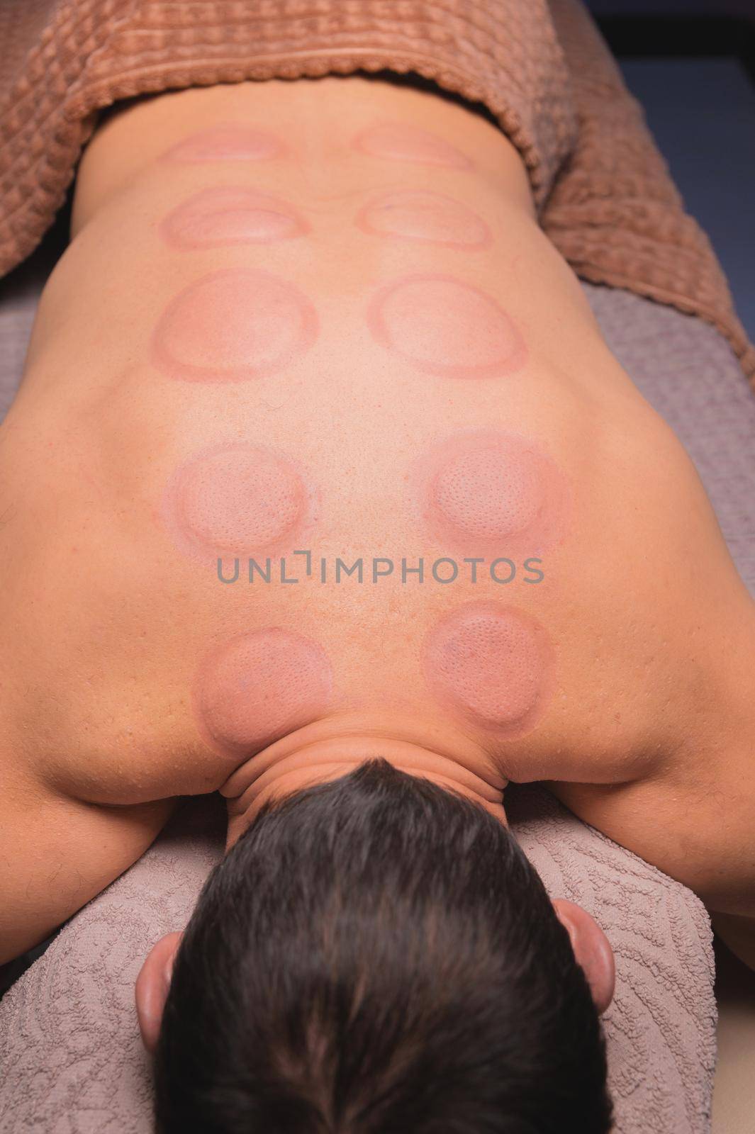 Man after cupping therapy on his back. Skin after cupping in traditional Chinese medicine. man returned from hijama cups in acupuncture therapy. Chinese traditional treatment. by yanik88