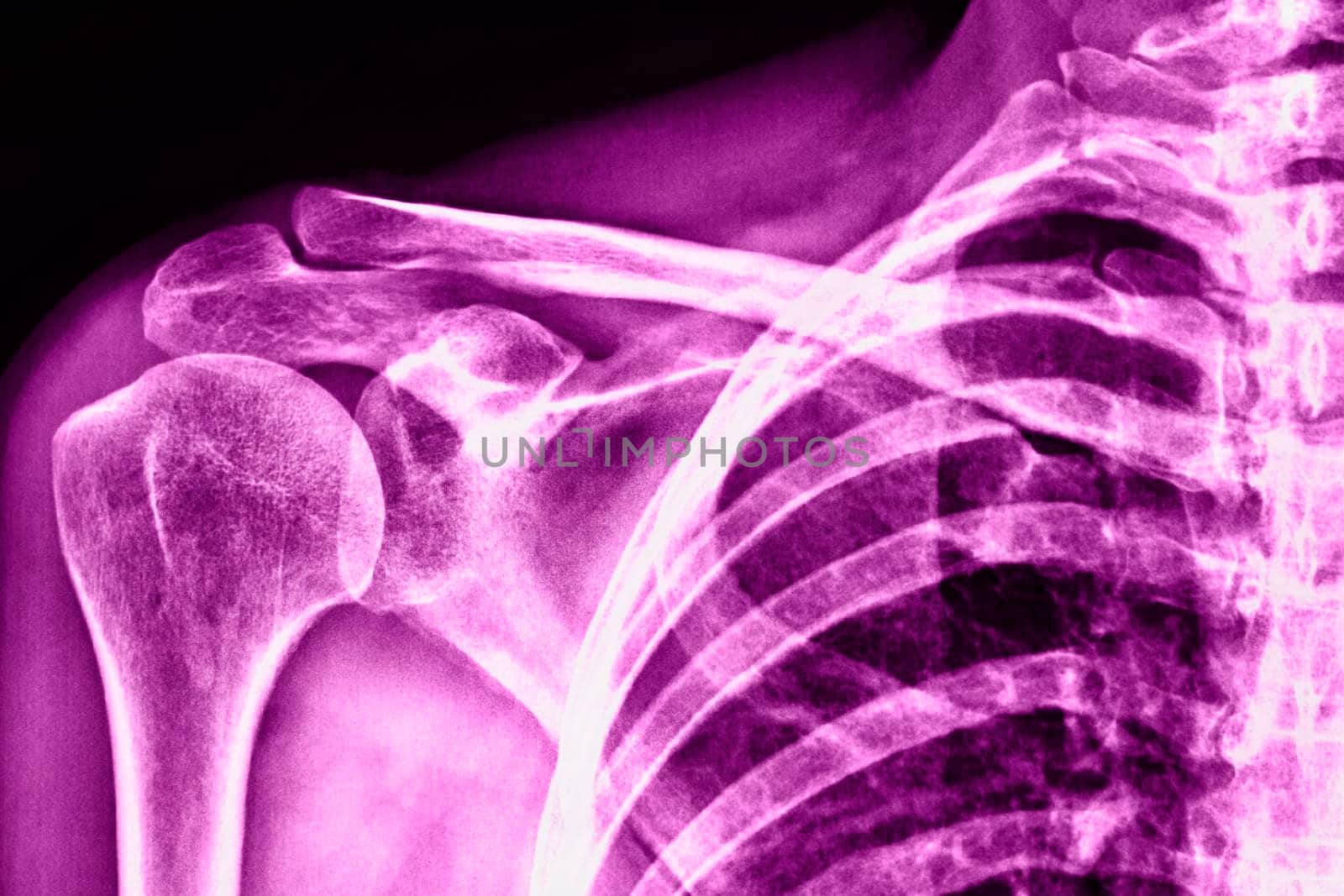 Close up of shoulder x-ray  by victimewalker