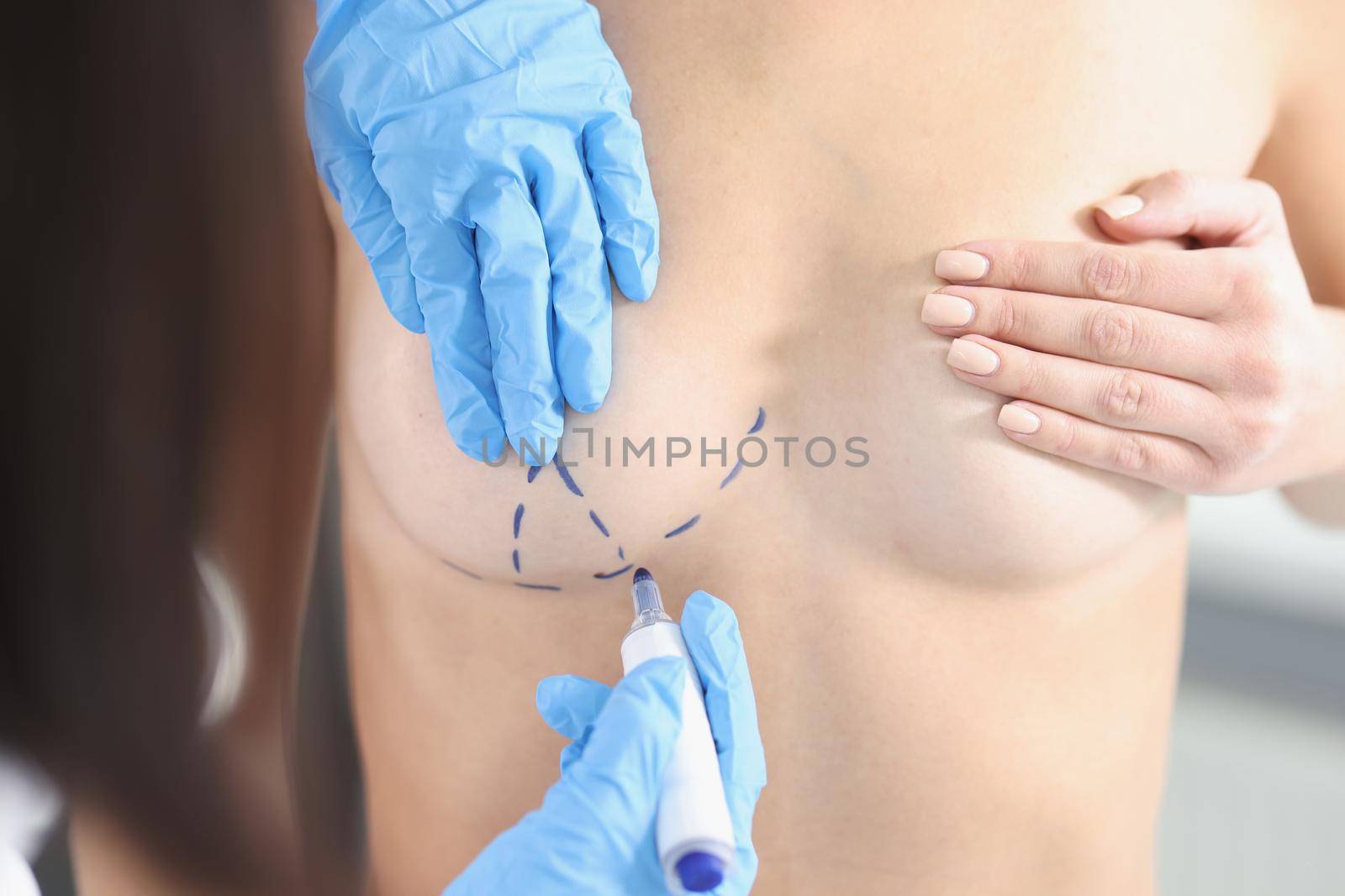 The doctor's hands draw with a marker on the female breast, close-up. Preparation for mammoplasty