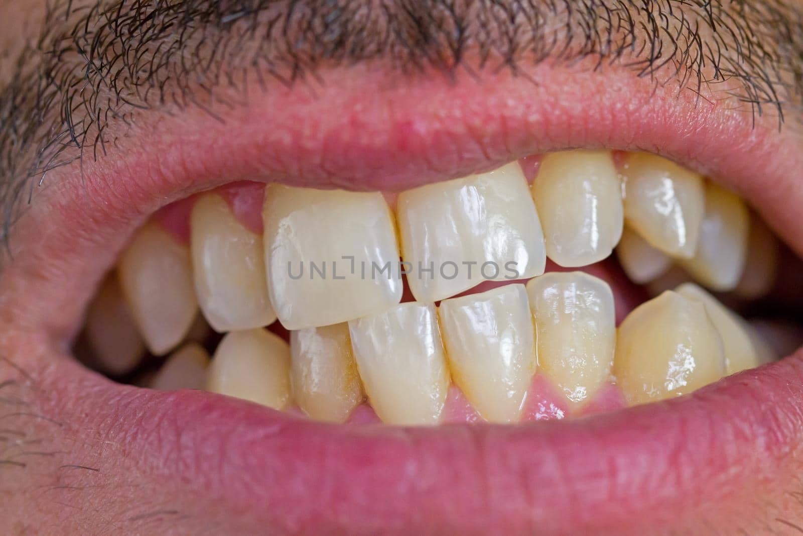 caucasian man mouth and irregular teeth closeup