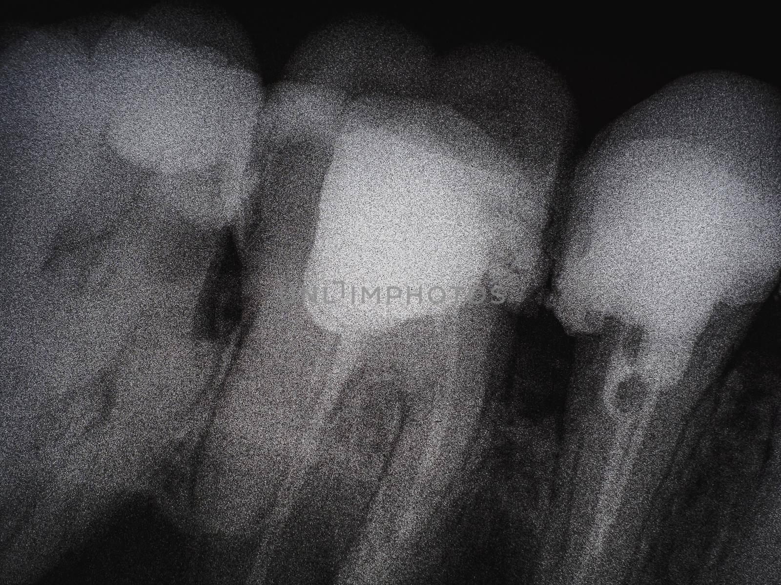 dental x-ray of several bad molars. caries by Alexander_V