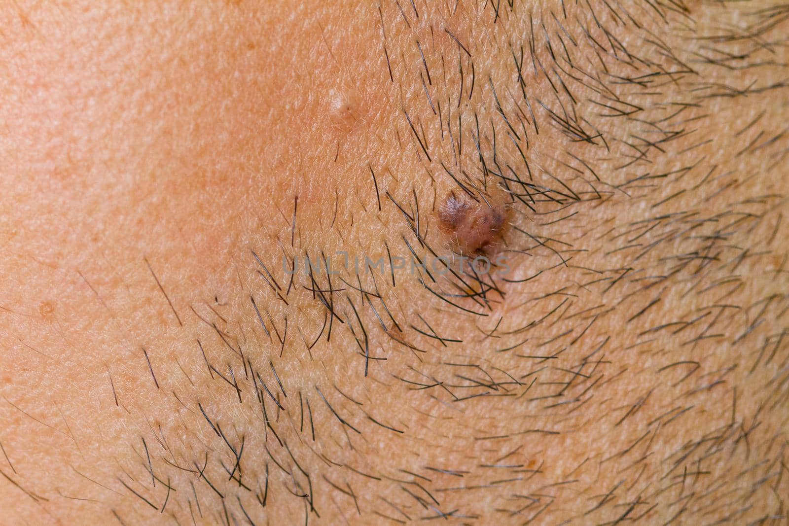 closeup view of caucasian man stub with wart