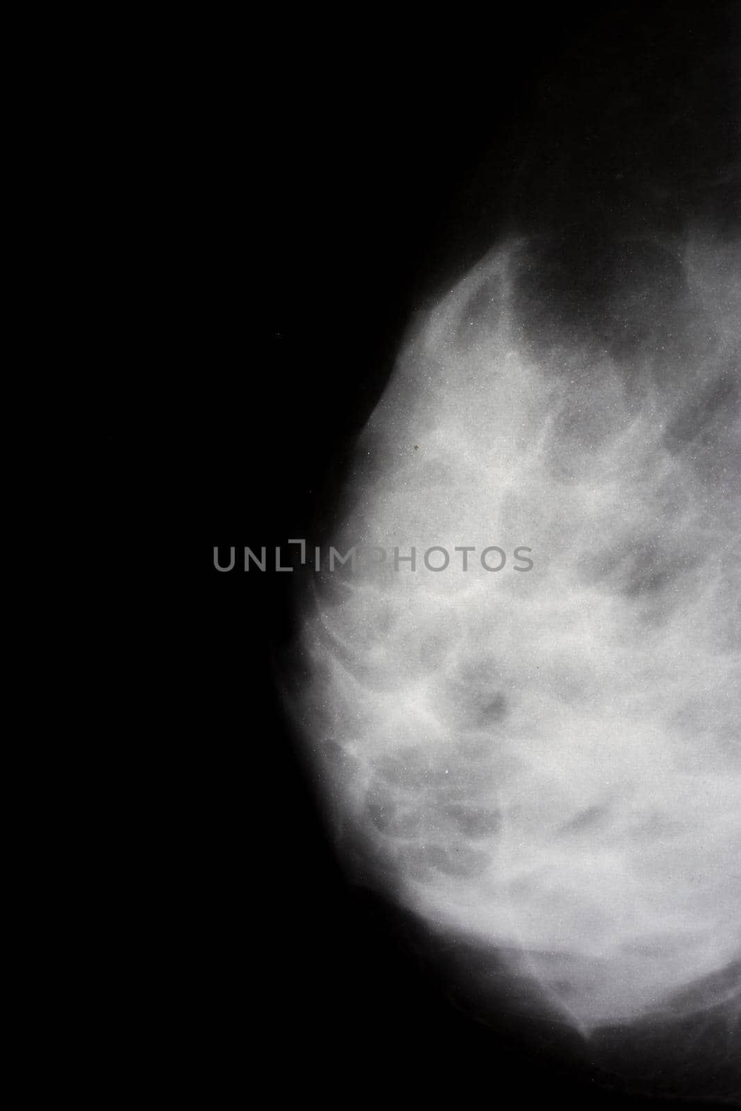 woman right breast xray closeup, vertical composition