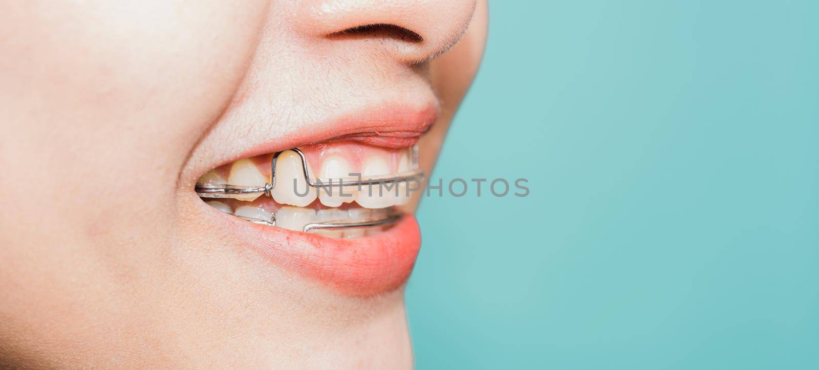 Close up white teeth of young Asian beautiful woman smiling wear silicone orthodontic retainers on teeth isolated on blue background, retaining tools after removable braces. Dental hygiene health