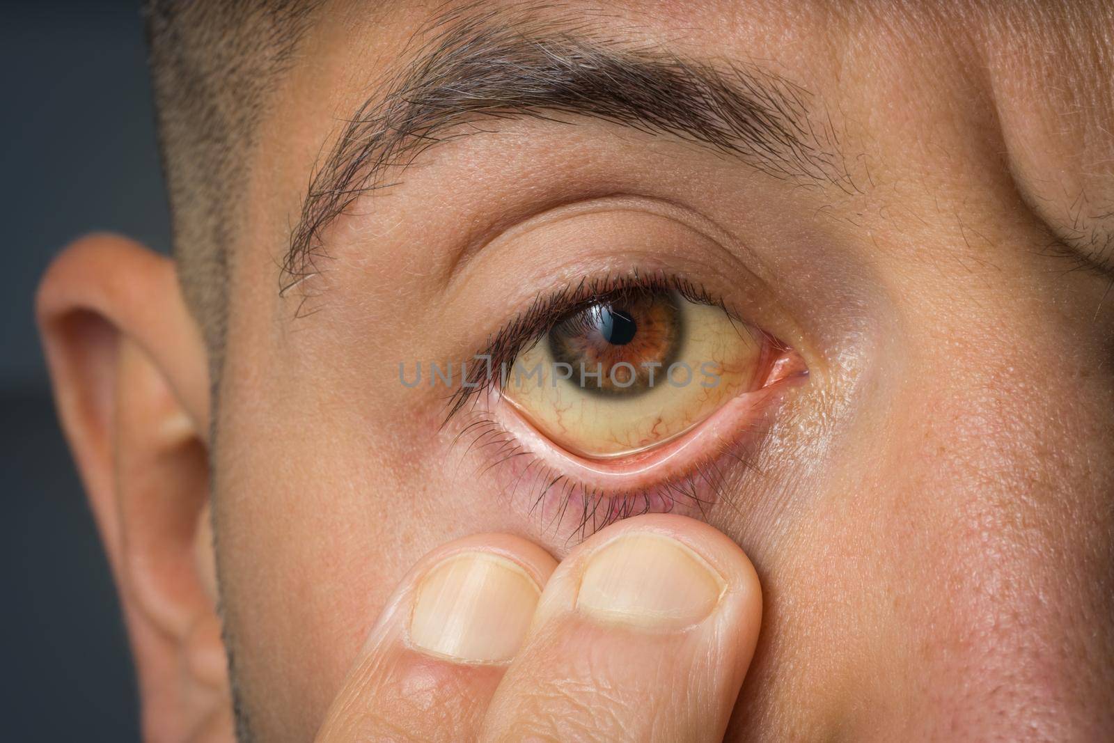 Sick man checking yellow eyes because of high bilirubin level, cirrhosis or hepatitis. Liver disease, liver problems or jaundice by DariaKulkova