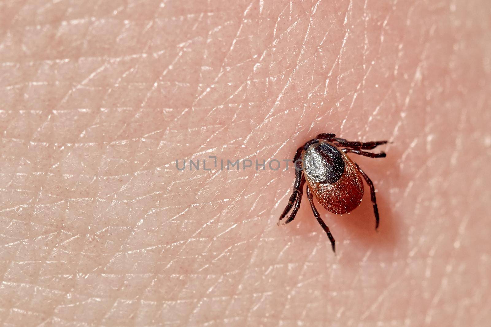 Sucking tick Macro photo on human skin. Ixodes ricinus. Bloated parasite bitten into pink irritated epidermis. Small red drops. Dangerous insect mite. Encephalitis, Lyme disease infection.