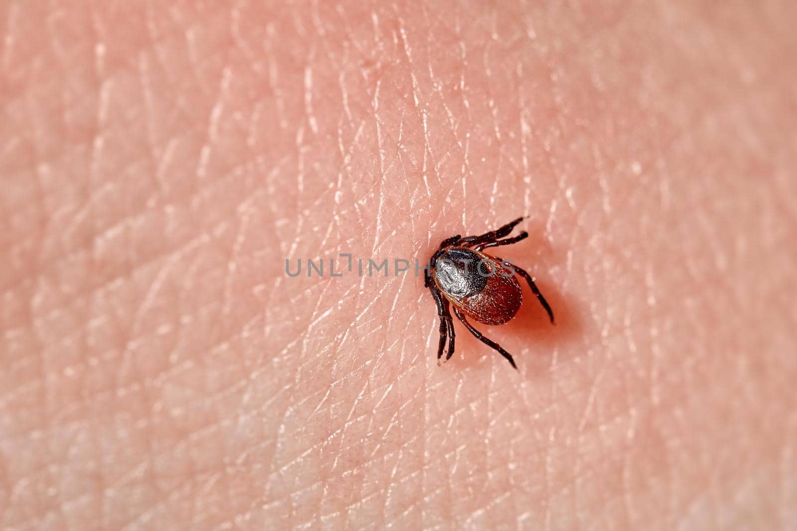 Sucking tick Macro photo on human skin. Ixodes ricinus. Bloated parasite bitten into pink irritated epidermis. Small red drops. Dangerous insect mite. Encephalitis, Lyme disease infection.