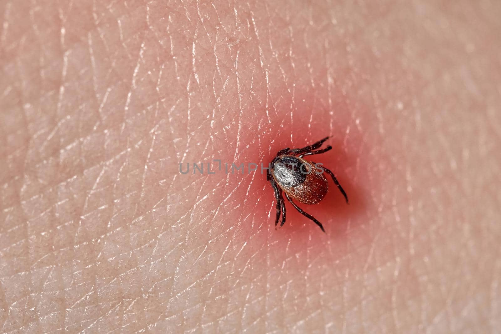 Sucking tick Macro photo on human skin. Ixodes ricinus. Bloated parasite bitten into pink irritated epidermis. Small red drops. Dangerous insect mite. Encephalitis, Lyme disease infection.