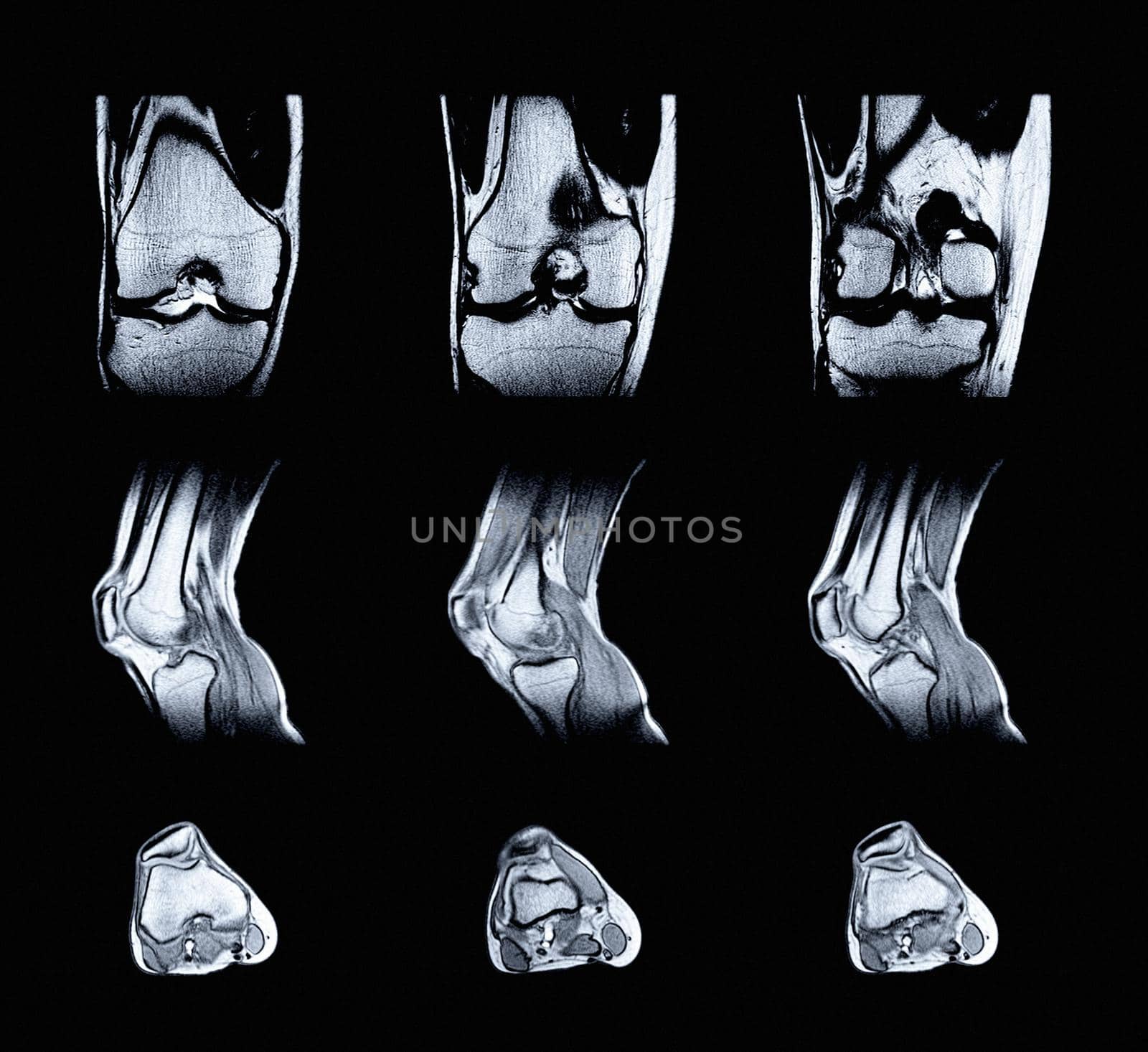 Magnetic resonance imaging (MRI) of right knee. Closed injury of the knee joint, with manifestations of arthrosis. by EvgeniyQW