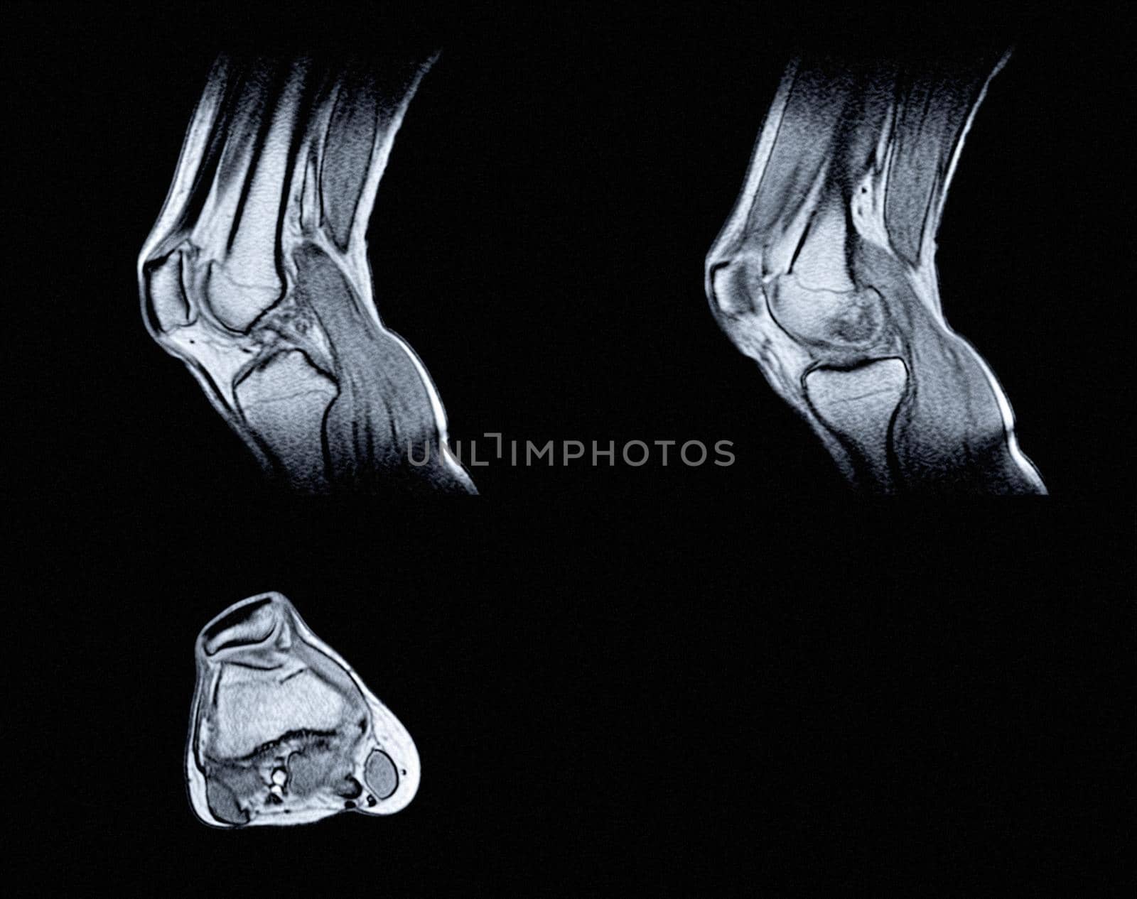 Magnetic resonance imaging (MRI) of right knee. Closed injury of the knee joint, with manifestations of arthrosis.